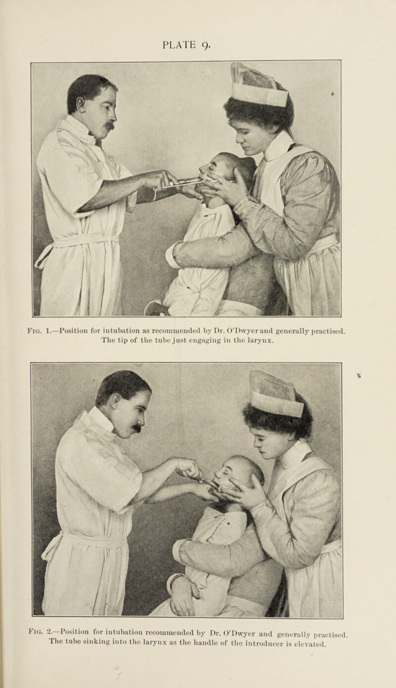 PLATE 9. Fig. 1.—Position for intubation as recoinmended l)y Dr. O’Dwyer and generally jiractised. The tip of the tube just engaging in the laryn.x. Fig. 2.—Position for intubation recommended by Dr. O'Dwyer and generally practised. The tube sinking into the larynx as the handle of the introducer is elevated.