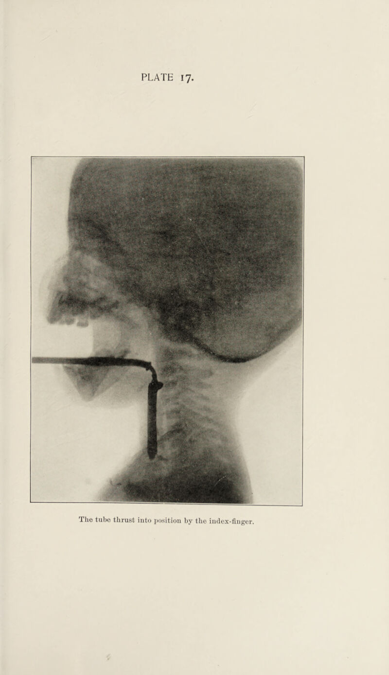 The tube thrust into i)asition by the index-finger