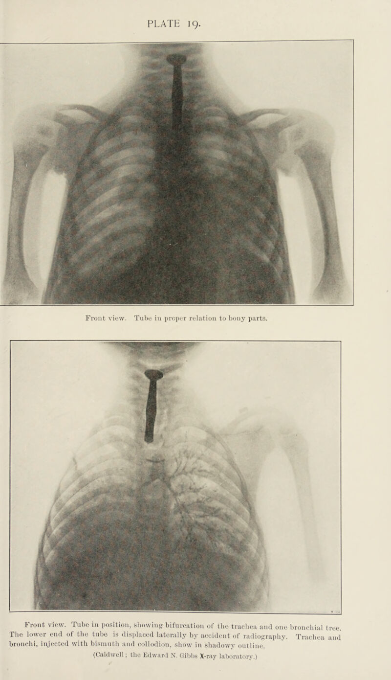 Front view. Tube in position, showing bifurcation of tlie tracliea and one bronchial tree. The lower end of the tube is disi)laced laterally by accident of radiography. Trachea and bronchi, injected with bismuth and collodion, show in shadowy outline. (Caldwell; the Edward N. Gibbs X-ray laboratory.)