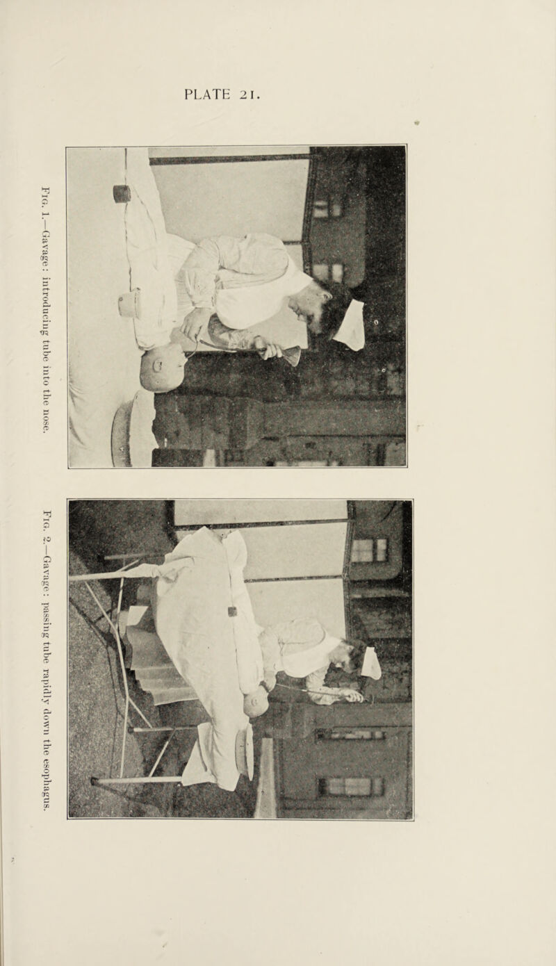 Fig. 1.—Gavage: introcluciug tube into the nose. Fig. 2.—Garage : passing tube rapidly down the esophagus. nr I 1 I 1