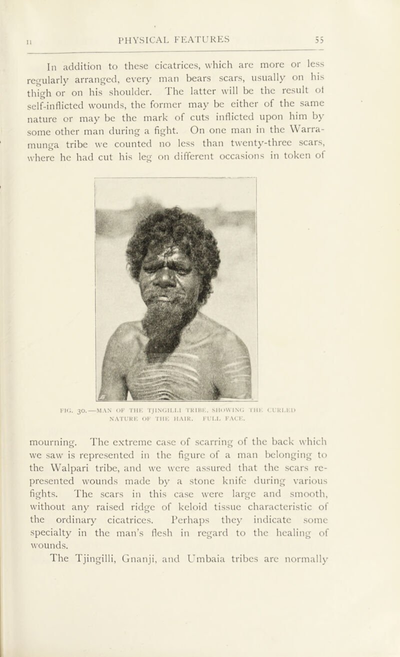 In addition to these cicatrices, which are more or less regularly arranged, every man bears scars, usually on his thigh or on his shoulder. The latter will be the result ot self-inflicted wounds, the former may be either of the same nature or may be the mark of cuts inflicted upon him by some other man during a fight. On one man in the Warra- munea tribe we counted no less than twenty-three scars, o where he had cut his leg on different occasions in token oi FIG. 30.—MAN OF THE TJINGILLl TKIBK. SHOWING I III; CURLED NATURE OF THE HAIR. FULL FACE. mourning. The extreme case of scarring of the back which we saw is represented in the figure of a man belonging to the Walpari tribe, and we were assured that the scars re- presented wounds made by a stone knife during various fights. The scars in this case were large and smooth, without any raised ridge of keloid tissue characteristic of the ordinary cicatrices. Perhaps they indicate some specialty in the man’s flesh in regard to the healing of wounds. The Tjingilli, Gnanji, and Umbaia tribes are normally