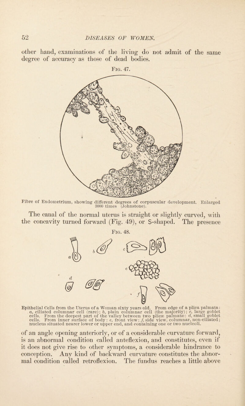 other hand, examinations of the living do not admit of the same degree of accuracy as those of dead bodies. Fig. 47. Fibre of Endometrium, showing different degrees of corpuscular development. Enlarged 3000 times (Johnstone). The canal of the normal uterus is straight or slightly curved, with the concavity turned forward (Fig. 49), or S-shaped. The presence Fig. 48. Epithelial Cells from the Uterus of a Woman sixty years old. From edge of a plica palmata: a, ciliated columnar cell (rare); b, plain columnar cell (the majority); c, large goblet cells. From the deepest part of the valley between two plicae palmatse: d, small goblet cells. From inner surface of body: e, front view; /, side view, columnar, non-ciliated; nucleus situated nearer lower or upper end, and containing one or two nucleoli. of an angle opening anteriorly, or of a considerable curvature forward, is an abnormal condition called anteflexion, and constitutes, even if it does not give rise to other symptoms, a considerable hindrance to conception. Any kind of backward curvature constitutes the abnor¬ mal condition called retroflexion. The fundus reaches a little above
