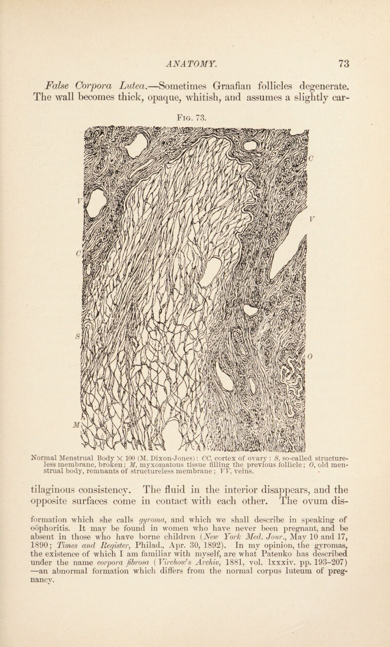 False Corpora Lutea.—Sometimes Graafian follicles degenerate. The wall becomes thick, opaque, whitish, and assumes a slightly car- Fig. 73. Normal Menstrual Body X 100 (M. Dixon-Jones): CC, cortex of ovary ; S, so-called structure¬ less membrane, broken; M, myxomatous tissue filling the previous follicle; 0, old men¬ strual body, remnants of structureless membrane ; VV, veins. tilaginous consistency. The fluid in the interior disappears, and the opposite surfaces come in contact with each other. The ovum dis- formation which she calls gyroma, and which we shall describe in speaking of oophoritis. It may be found in women who have never been pregnant, and be absent in those who have borne children (New York Med. Jour., May 10 and 17, 1890; Times and Register, Philad., Apr. 30, 1892). In my opinion, the gyromas, the existence of which I am familiar with mvself, are what Patenko has described under the name corpora fibrosa (Virchow’s Archiv, 1881, vol. lxxxiv. pp. 193-207) —an abnormal formation which differs from the normal corpus luteum of preg¬ nancy.