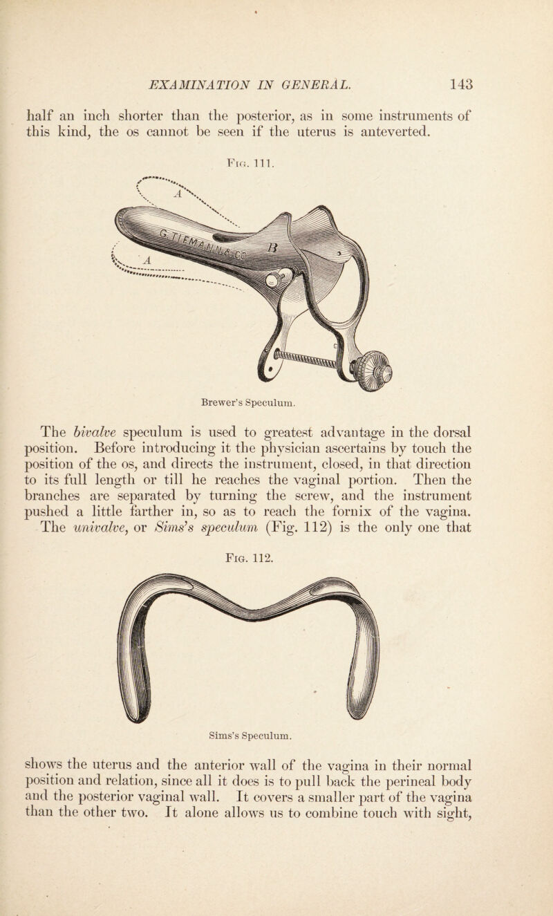 half an inch shorter than the posterior, as iii some instruments of this kind, the os cannot be seen if the uterus is anteverted. Fro. 111. Brewer’s Speculum. The bivalve speculum is used to greatest advantage in the dorsal position. Before introducing it the physician ascertains by touch the position of the os, and directs the instrument, closed, in that direction to its full length or till he reaches the vaginal portion. Then the branches are separated by turning the screw, and the instrument pushed a little farther in, so as to reach the fornix of the vagina. The univalve, or Sims’s speculum (Fig. 112) is the only one that Fig. 112. shows the uterus and the anterior wall of the vagina in their normal position and relation, since all it does is to pull back the perineal body and the posterior vaginal wall. It covers a smaller part of the vagina than the other two. It alone allows us to combine touch with sight,