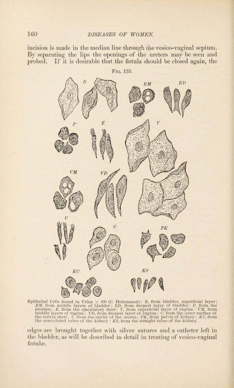 incision is made in the median line through the vesico-vaginal septum. By separating the lips the openings of the ureters may be seen and probed. If it is desirable that the fistula should be closed again, the Fig. 135. Epithelial Cells found in Urine X 500 (C. Heitzmann): B, from bladder, superficial layer; BM, from middle layers of bladder ; BD, from deepest layer of bladder; P, from the prostate; E, from the ejaculatory duct; V, from superficial layer of vagina; VM, from middle layers of vagina ; VD, from deepest layer of vagina ; C, from the outer surface of the cervix uteri; 77, from the cavity of the uterus; PK, from pelvis of kidney ; KC, from the convoluted tubes of the kidney ; KS, from the straight tubes of the kidney. edges are brought together with silver sutures and a catheter left in the bladder, as will be described in detail in treating of vesico-vaginal fistuke.
