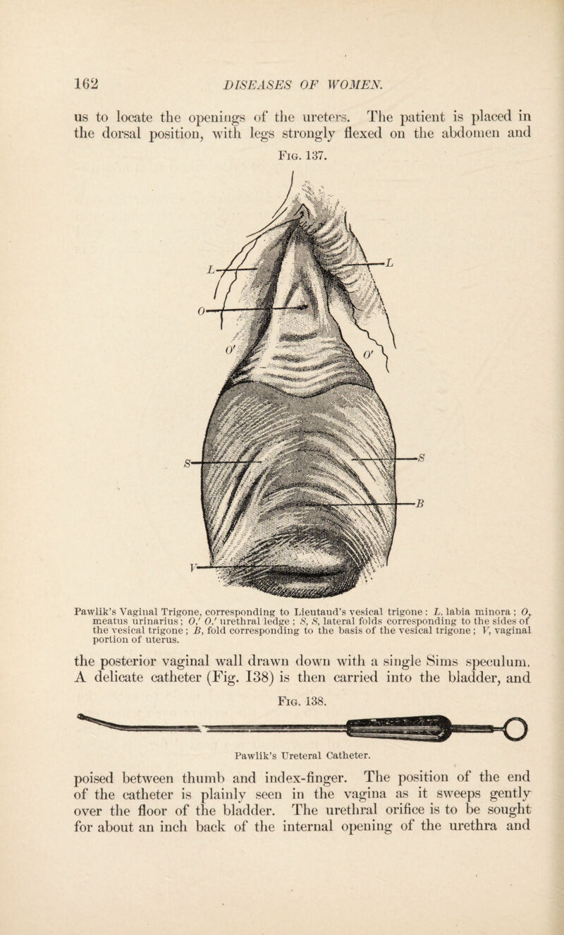 us to locate the openings of the ureters. The patient is placed in the dorsal position, with legs strongly flexed on the abdomen and Fig. 137. Pawlik’s Vaginal Trigone, corresponding to Lieutaud’s vesical trigone : L, labia minora ; 0, meatus urinarius ; 0/ 0/ urethral ledge ; S, S, lateral folds corresponding to the sides of the vesical trigone ; B, fold corresponding to the basis of the vesical trigone; V, vaginal portion of uterus. the posterior vaginal wall drawn down with a single Sims speculum. A delicate catheter (Fig. 138) is then carried into the bladder, and Fig. 138. Pawlik’s Ureteral Catheter. poised between thumb and index-finger. The position of the end of the catheter is plainly seen in the vagina as it sweeps gently^ over the floor of the bladder. The urethral orifice is to be sought for about an inch back of the internal opening of the urethra and