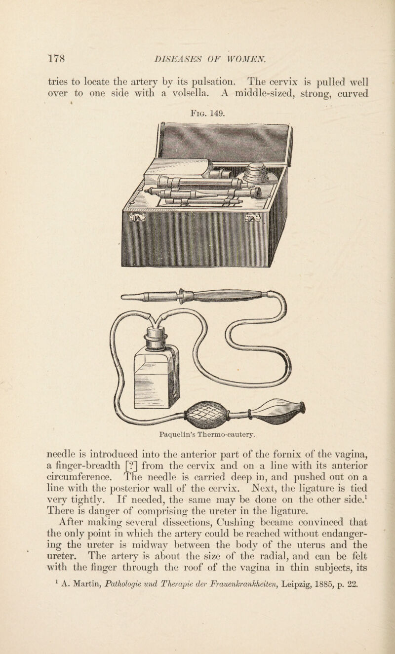 tries to locate the artery by its pulsation. The cervix is pulled well over to one side with a volsella. A middle-sized, strong, curved Fiu. 149. needle is introduced into the anterior part of the fornix of the vagina, a finger-breadth [?] from the cervix and on a line with its anterior circumference. The needle is carried deep in, and pushed out on a line with the posterior wall of the cervix. Next, the ligature is tied very tightly. If needed, the same may be done on the other side.1 There is danger of comprising the ureter in the ligature. After making several dissections, Cushing became convinced that the only point in which the artery could be reached without endanger¬ ing the ureter is midway between the body of the uterus and the ureter. The artery is about the size of the radial, and can be felt with the finger through the roof of the vagina in thin subjects, its 1 A. Martin, Pathologie und Therapie der Frauenkrankheiten, Leipzig, 1885, p. 22.