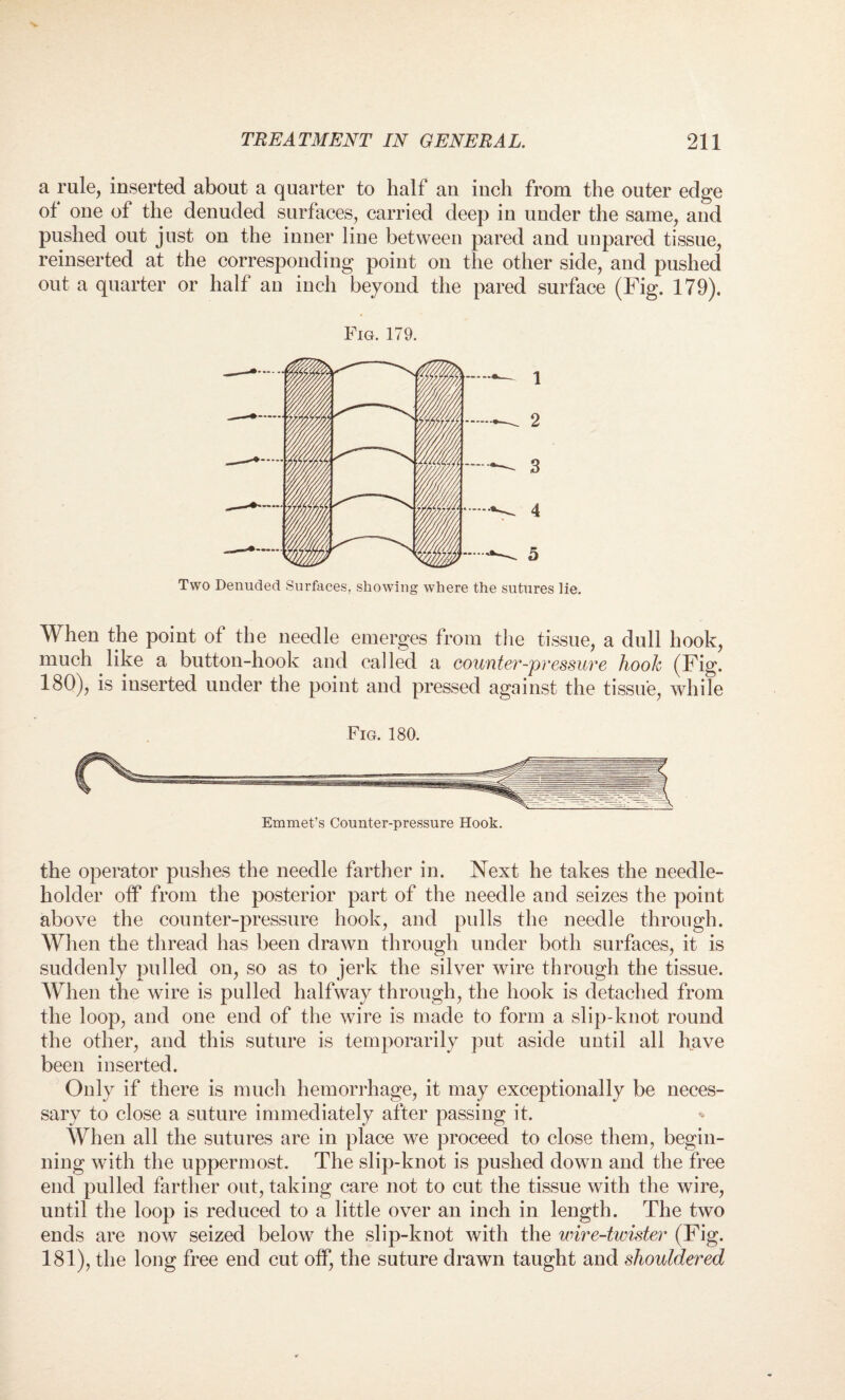 a rule, inserted about a quarter to half an inch from the outer edge ol one of the denuded surfaces, carried deep in under the same, and pushed out just on the inner line between pared and unpared tissue, reinserted at the corresponding point on the other side, and pushed out a quarter or half an inch beyond the pared surface (Fig. 179). Fig. 179. 1 2 3 4 5 Two Denuded Surfaces, showing where the sutures lie. When the point of the needle emerges from the tissue, a dull hook, much like a button-hook and called a counter-pressure hook (Fig. 180), is inserted under the point and pressed against the tissue, while Fig. 180. the operator pushes the needle farther in. Next he takes the needle- holder off from the posterior part of the needle and seizes the point above the counter-pressure hook, and pulls the needle through. When the thread has been drawn through under both surfaces, it is suddenly pulled on, so as to jerk the silver wire through the tissue. When the wire is pulled halfway through, the hook is detached from the loop, and one end of the wire is made to form a slip-knot round the other, and this suture is temporarily put aside until all have been inserted. Only if there is much hemorrhage, it may exceptionally be neces¬ sary to close a suture immediately after passing it. When all the sutures are in place we proceed to close them, begin¬ ning with the uppermost. The slip-knot is pushed down and the free end pulled farther out, taking care not to cut the tissue with the wire, until the loop is reduced to a little over an inch in length. The two ends are now seized below the slip-knot with the wire-twister (Fig. 181), the long free end cut off, the suture drawn taught and shouldered