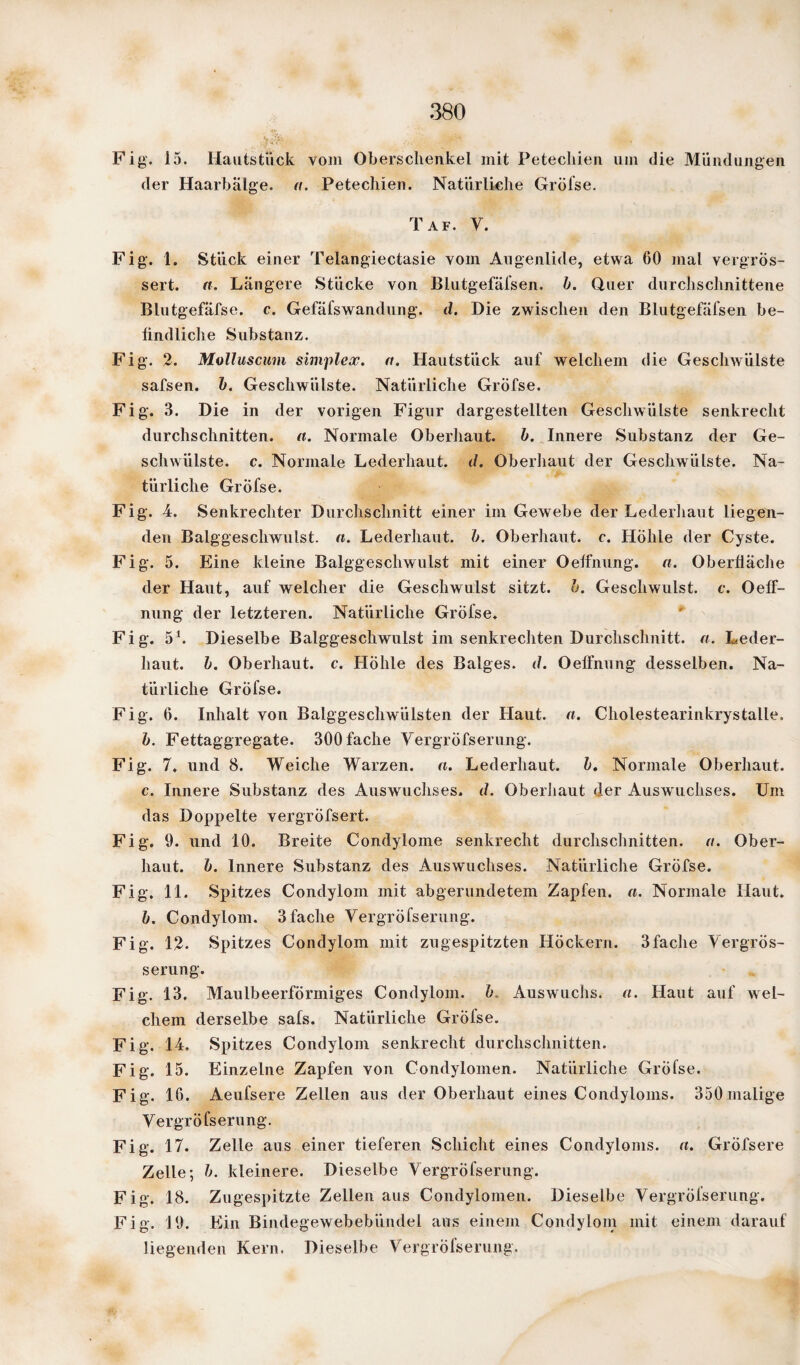 Fig. 15. Hautstuck vom Oberschenkel mit Petechien um die Mündungen der Haarbälge, a. Petechien. Natürliche Gröfse. Taf. y. Fig. 1. Stück einer Telangiectasie vom Angenlide, etwa 60 mal vergrÖs- sert. a. Längere Stücke von Blutgefäfsen. b. Quer durchschnittene Blutgefäfse. c. Gefäfs Wandung. d. Die zwischen den Blutgefäfsen be¬ findliche Substanz. Fig. 2. Molluscum simplex. n. Hautstück auf welchem die Geschwülste safsen. b. Geschwülste. Natürliche Gröfse. Fig. 3. Die in der vorigen Figur dargestellten Geschwülste senkrecht durchschnitten, a. Normale Oberhaut, b. Innere Substanz der Ge¬ schwülste. c. Normale Lederhaut. </. Oberhaut der Geschwülste. Na¬ türliche Gröfse. Fig. 4. Senkrechter Durchschnitt einer im Gewebe der Lederhaut liegen¬ den Balggeschwulst, n. Lederhaut. b. Oberhaut, c. Höhle der Cyste. Fig. 5. Eine kleine Balggeschwulst mit einer Oelfnung. n. Oberfläche der Haut, auf welcher die Geschwulst sitzt, b. Geschwulst, c. Oeff- nung der letzteren. Natürliche Gröfse. Fig. 51. Dieselbe Balggeschwulst im senkrechten Durchschnitt, a. Leder¬ haut. b. Oberhaut, c. Höhle des Balges, d. Oelfnung desselben. Na¬ türliche Gröfse. Fig. 6. Inhalt von Balggeschwülsten der Haut. a. Cholestearinkrystalle. b. Fettaggregate. 300 fache VergrÖfserung. Fig. 7, und 8. Weiche Warzen, a. Lederhaut, b. Normale Oberhaut. c. Innere Substanz des Auswuchses, d. Oberhaut der Auswuchses. Um das Doppelte vergröfsert. Fig. 9. und 10. Breite Condylome senkrecht durchschnitten, a. Ober¬ haut. b. Innere Substanz des Auswuchses. Natürliche Gröfse. Fig. 11. Spitzes Condylom mit abgerundetem Zapfen, a. Normale Haut. b. Condylom. 3 fache VergrÖfserung. Fig. 12. Spitzes Condylom mit zugespitzten Höckern. 3fache Vergrös- serung. Fig. 13. Maulbeerförmiges Condylom. l\ Auswuchs, a. Haut auf wel¬ chem derselbe safs. Natürliche Grölse. Fig. 14. Spitzes Condylom senkrecht durchschnitten. Fig. 15. Einzelne Zapfen von Condylomen. Natürliche Gröfse. Fig. 16. Aeufsere Zellen aus der Oberhaut eines Condyloms. 350malige VergrÖfserung. Fig. 17. Zelle aus einer tieferen Schicht eines Condyloms, a. GrÖfsere Zelle; b. kleinere. Dieselbe VergrÖfserung. Fig. 18. Zugespitzte Zellen aus Condylomen. Dieselbe VergrÖfserung. Fig. 19. Ein Bindegewebebündel aus einem Condylom mit einem darauf liegenden Kern. Dieselbe VergrÖfserung.