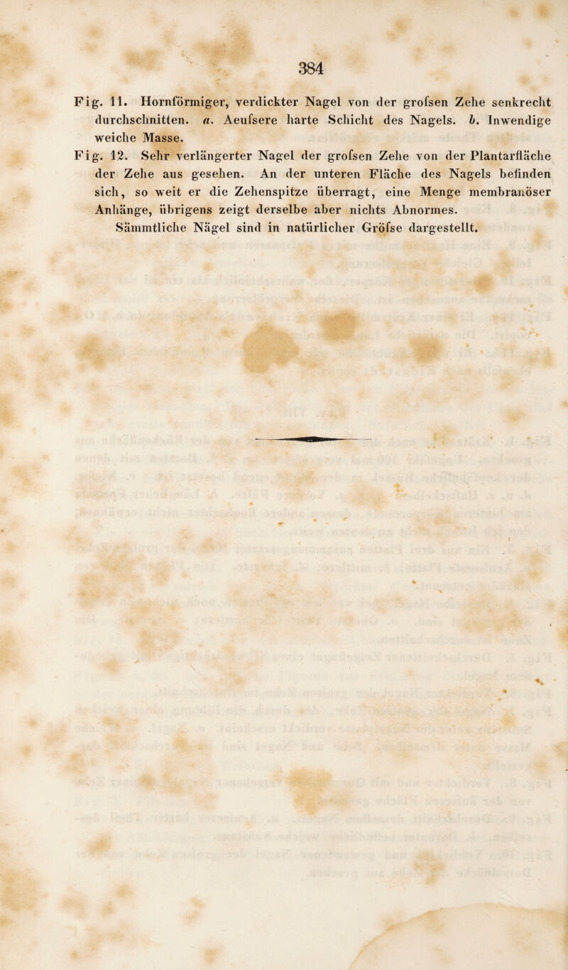 Fig. 11. Hornförmiger, verdickter Nagel von der grofsen Zehe senkrecht durchschnitten, a. Aeufsere harte Schicht des Nagels, h. Inwendige weiche Masse. Fig. 12. Sehr verlängerter Nagel der grofsen Zehe von der Plantarfläche der Zehe aus gesehen. An der unteren Fläche des Nagels befinden sich, so weit er die Zellenspitze überragt, eine Menge membranöser Anhänge, übrigens zeigt derselbe aber nichts Abnormes. Sämmtliche Nägel sind in natürlicher GrÖfse dargestellt.