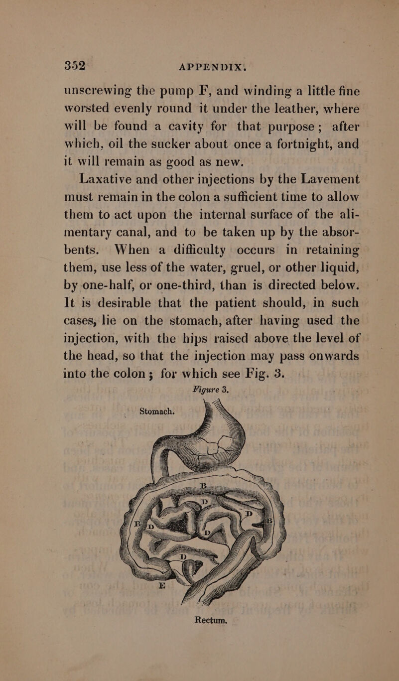 unscrewing the pump F, and winding a little fine worsted evenly round it under the leather, where will be found a cavity for that purpose; after which, oil the sucker about once a fortnight, and it will remain as good as new. Laxative and other injections by the Lavement must remain in the colon a sufficient time to allow them to act upon the internal surface of the ali- mentary canal, and to be taken up by the absor- bents. When a difficulty occurs in retaining them, use less of the water, gruel, or other liquid, by one-half, or one-third, than is directed below. lt is desirable that the patient should, in such cases, lie on the stomach, after having used the injection, with the hips raised above the level of the head, so that the injection may pass onwards into the colon; for which see Fig. 3. Figure 3. Stomach.