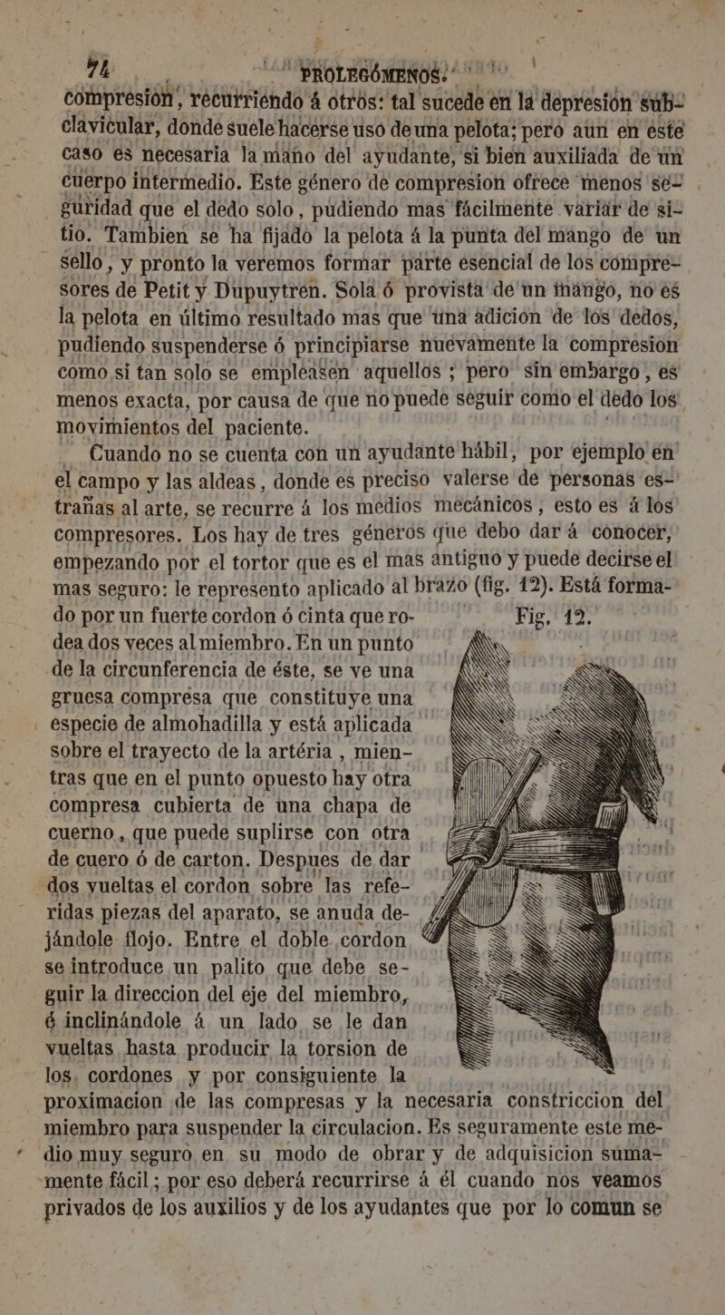 - : 7h. ¡ AMERO | compresión recurriendo 4 otros: tal sucede en la depresión sub- clavicular, donde suele hacerse usó de una pelota; pero aun en este caso es necesaria la maño del ayudante, si bien auxiliada de un cuerpo intermedio. Este género de compresion ofrece menos se= tio. Tambien se ha fijado la pelota 4 la punta del mango de un sores de Petit y Dupuytren. Sola 6 provista de un inango, no es la pelota en último resultado mas que tuna adición de los dedos, pudiendo suspenderse 6 principiarse nuevamente la compresion como si tan solo se empleasen aquellos ; pero' sin embargo, es menos exacta, por causa de que no puede seguir comio el dedo los' movimientos del paciente. j Cuando no se cuenta con un ayudante hábil, por ejemplo en el campo y las aldeas, qu es preciso valerse de personas es- trañas al arte, se recurre à los medios mecánicos , esto es á los compresores. Los hay de tres géneros que debo dde à conocer, empezando por el tortor que es el mas antiguo y puede decirse el mas seguro: le represento aplicado al brazo (fig. 12). Está forma- do por un fuerte cordon 6 cinta quero- Fig, 12. dea dos veces al miembro. En un punto gruesa compresa que constituye una especie de almohadilla y está aplicada $ sobre el trayecto de la artéria , mien- tras que en el punto opuesto Le otra compresa cubierta de una chapa de cuerno, que puede suplirse con otra de cuero ó de carton. Despues de dar Ha dos vueltas el cordon. sobre las refe- /, ridas piezas del aparato, se anuda de- / jándole- flojo. Entre el doble cordon ; se introduce un palito que debe se- guir la direccion del eje del miembro, é inclinändole 4 un lado se le dan vueltas hasta producir la torsion de los. cordones y por consiguiente la proximacion de las compresas y la necesaria constriccion del mente fácil ; por eso deberá recurrirse á él cuando nos veamos privados de los auxilios y de los ayudantes que por lo comun se