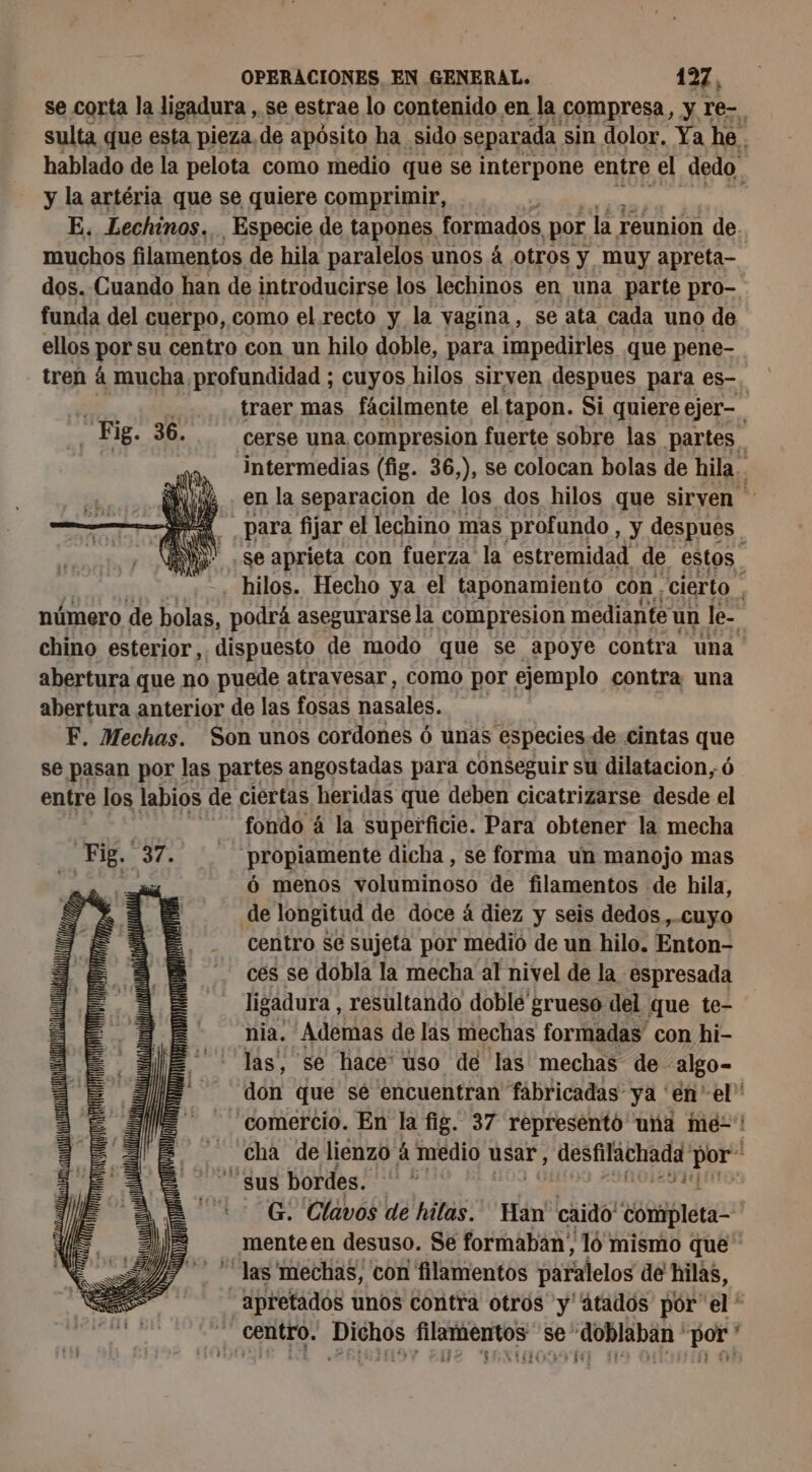 se corta la ligadura, se estrae lo contenido en la compresa, y re- sulta que esta pieza, de apósito ha sido separada sin dolor. Ya he. hablado de la pelota como medio que se interpone entre el dedo y la artéria que se quiere comprimir, | E. Lechinos, Especie de tapones, formados por la reunion de muchos filamentos de hila paralelos unos 4 otros y muy apreta- dos. Cuando han de introducirse los lechinos en una parte pro- funda del cuerpo, como el recto y la vagina, se ata cada uno de ellos por su centro con un hilo doble, para impedirles que pene- tren á mucha profundidad ; cuyos hilos sirven despues para es-. E a traer mas fâcilmente el tapon. Si quiere ejer- . Fig. 36. cerse una compresion fuerte sobre las partes intermedias (fig. 36,), se colocan bolas de hila... Nil en la separacion de los dos hilos que sirven Fai para fijar el lechino mas profundo, y despues | Y ,se aprieta con fuerza la estremidad de estos. -. hilos. Hecho ya el taponamiento con cierto | número de holas, podrá asegurarse la compresion mediante un Je- chino esterior, dispuesto de modo que se apoye contra una abertura que no puede atravesar, como por ejemplo contra una abertura anterior de las fosas nasales. F. Mechas. Son unos cordones 6 unas especies. de cintas que se pasan por las partes angostadas para conseguir su dilatacion,ó entre los labios de ciertas heridas que deben cicatrizarse desde el fondo á la superficie. Para obtener la mecha propiamente dicha , se forma un manojo mas 6 menos PA de filamentos de hila, de longitud de doce á diez y seis dedos,..cuyo centro se sujeta por medio de un hilo. Enton- ces se dobla la mecha al nivel de la espresada ligadura, resultando doble' grueso del que te- nia. Ademas de las mechas formadas con hi- las, se hace uso de las mechas de algo- don que se encuentran fabricadas ya 'en' el comercio. En la fig. 37 representó una me-*! cha de lienzo á medio Usar, aesmatiaia + de Sus bordes. G. Clavos de hilas. Hán caido' pitéta menteen desuso. Se formaban', 10 mismo que ‘las mechas, con filamentos paralelos de hilas, ES apretados unos contra otros y'átados pôr el ' 5: e - centro. Dichos filamentos se doblaban ‘por ' $