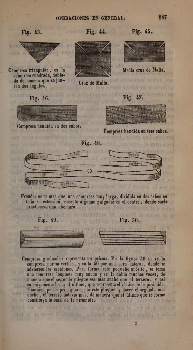 Compresa triangular , es la compresa cuadrada, dobla- da de manera que se jun- tan dos angulos. > Compresa hendida en dos cabos. Compresa hendida en tros cabos. Fig. 48. Ta anis let] dE A io rl fill il AA OS PATTES Ar —— male Fronda: no es mas que una compresa muy larga, dividida en dos cabos en toda su estension, escepto algunas pulgadas en el centro, donde suele practicarse una abertura. Fig. 49. Fig. 50. Las + Mu = Compresa graduada: representa un prisma. En la figura 49 se ve la compresa por su vértice , y en la 50 por una cara lateral, donde se advierten los escalones. Para formar este pequeño apósito , se toma una compresa longueta muy ancha y se la dobla muchas veces, de manera que el segundo pliegue sea mas ancho que el tercero, y asi sucesivamente hasta el último, que representa el vértice de la pirámide. Tambien puede principiarse por este pliegue y hacer el segundo mas ancho , el tercero todavia mas, de manera que el último que se forme constituya la base de la pirámide.: