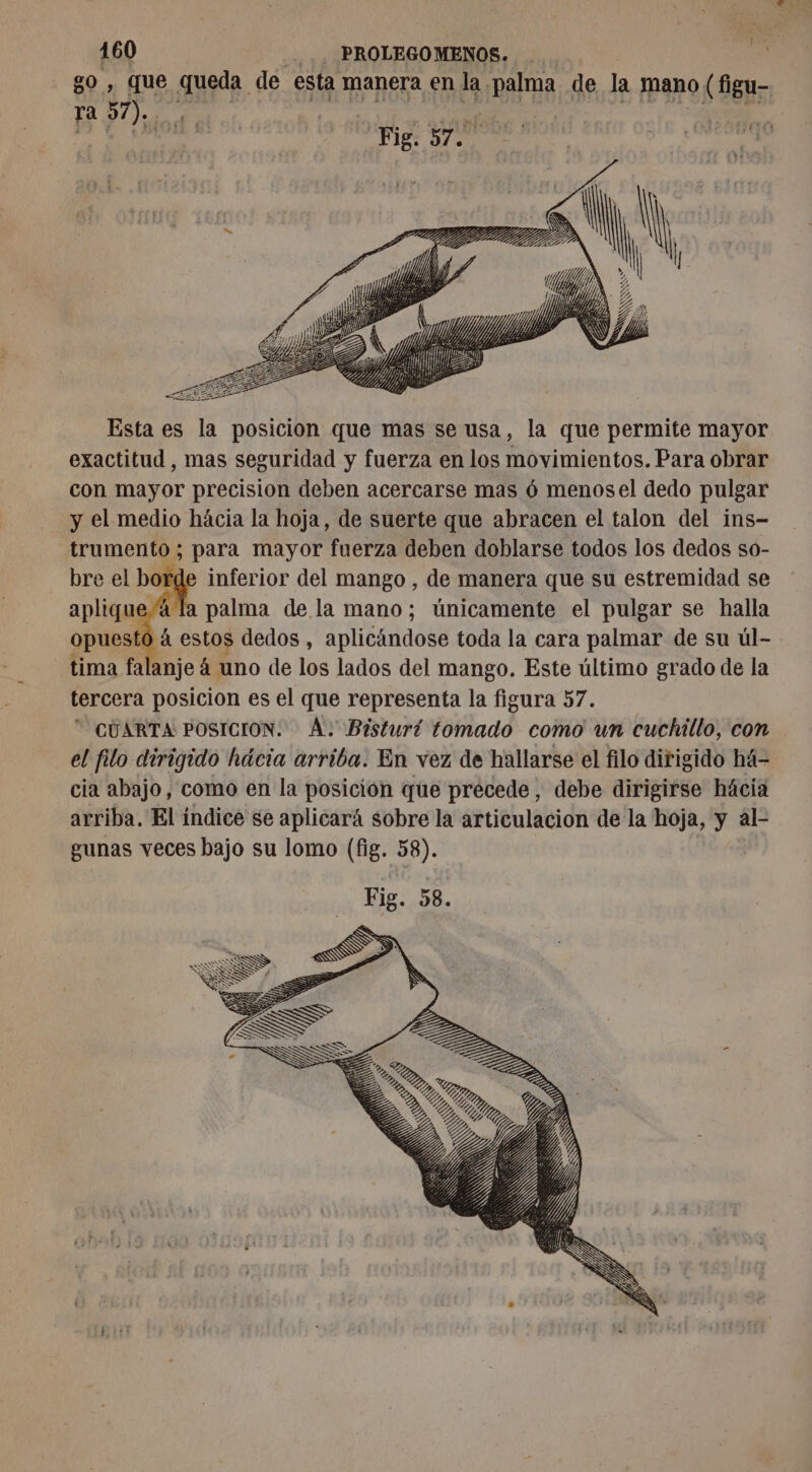 LA 80, que queda de esta manera en la palma de la mano (figu- EA NE RE VANPE EDS Om Esta es la posicion que mas se usa, la que permite mayor exactitud, mas seguridad y fuerza en los movimientos. Para obrar con mayor precision deben acercarse mas 6 menosel dedo pulgar y el medio hácia la hoja, de suerte que abracen el talon del ins- trumento ; para mayor fuerza deben doblarse todos los dedos so- e “4 la palma de la mano; únicamente el pulgar se halla - tima falanje 4 uno de los lados del mango. Este último grado de la tercera posicion es el que representa la figura 57.  CUARTA POSICION. A. Bisturí tomado como un cuchillo, con el filo dirigido hácia arriba. En vez de hallarse el filo dirigido h4- cia abajo, como en la posición que precede, debe dirigirse hácia arriba. El índice se aplicará sobre la articulacion de la hoja, y al- gunas veces bajo su lomo (fig. 58). |