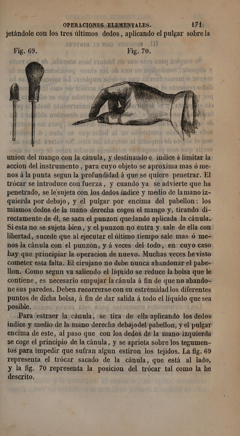 jetándole con los tres últimos dedos, esp el pulgar sobre la Fig. 69. bs due UA He 70. union del mango con la cánula, y destinando e indice á limitar la accion del instrumento , para cuyo objeto se aproxima mas ó me- nos á la punta segun la profundidad á que se quiere penetrar. El trócar se introduce con fuerza, y cuando ya se advierte que ha penetrado, se le'sujeta con los dedos indice y medio de lamano iz- quierda por debajo, y el pulgar por encima del pabellon: los mismos dedos de la mano derecha cogen el mango y, tirando di- rectamente de él, se saca el punzon quedando aplicada la cánula. Siesta no sesujeta bien, y el punzon no entra y. sale de ella con ' libertad, sucede que al ejecutar el último tiempo sale mas 6 me- nos la cánula con el punzon, y á veces del todo, en: cuyo caso hay:que principiar la operacion de nuevo. Muchas veces he visto cometer esta falta. El cirujano no debe nunca abandonar el pabe- llon. Como segun va saliendo el líquido se reduce la bolsa que le contiene, es necesario empujar la cánula à fin de que no abando- nesus paredes. Deben recorrerse con su estremidad los diferentes puntos de dicha bolsa, á fin de dar sabido á todo el líquido que sea posible. | Para /estraer la hebrea se tira de ella aplicando los dedos índice y medio: de la:mano derecha debajodel pabellon, y el pulgar encima de este, al paso que con los dedos de la mano izquierda se coge el principio de la cánula, y se aprieta sobre los tegumen- tos para impedir que sufran algun estiron los tejidos. La fig. 69 representa el trócar sacado de la cánula, que está al lado, y la fig. 70 representa la posicion del trócar tal como la he descrito.