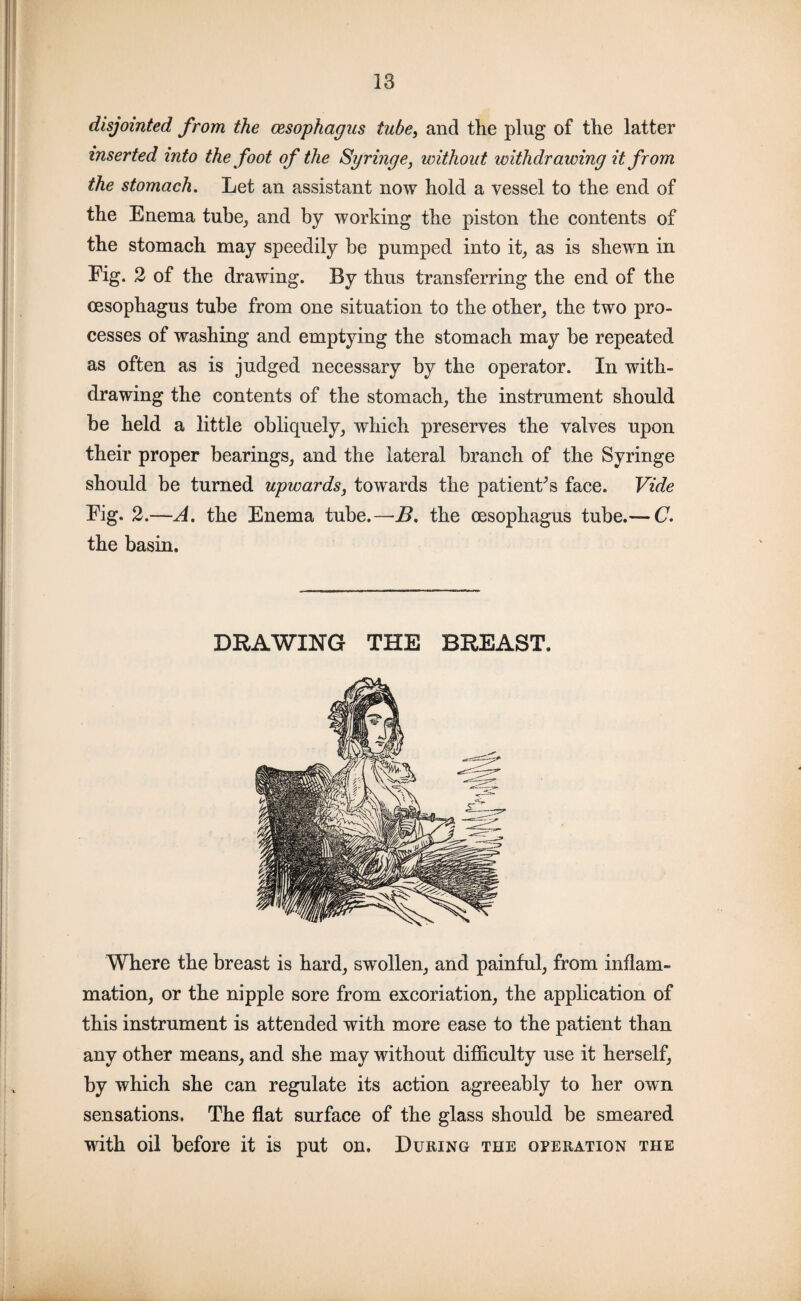 disjointed from the oesophagus tube, and the plug of the latter inserted into the foot of the Syringe, without toithdr awing it from the stomach. Let an assistant now hold a vessel to the end of the Enema tube, and by working the piston the contents of the stomach may speedily be pumped into it, as is shewn in Fig. 2 of the drawing. By thus transferring the end of the oesophagus tube from one situation to the other, the two pro¬ cesses of washing and emptying the stomach may be repeated as often as is judged necessary by the operator. In with¬ drawing the contents of the stomach, the instrument should be held a little obliquely, which preserves the valves upon their proper bearings, and the lateral branch of the Syringe should be turned upwards, towards the patienks face. Vide Fig. 2.—A. the Enema tube.—B, the oesophagus tube.— C. the basin. DRAWING THE BREAST. Where the breast is hard, swollen, and painful, from inflam¬ mation, or the nipple sore from excoriation, the application of this instrument is attended with more ease to the patient than any other means, and she may without difficulty use it herself, by which she can regulate its action agreeably to her own sensations. The flat surface of the glass should be smeared with oil before it is put on. During the operation the