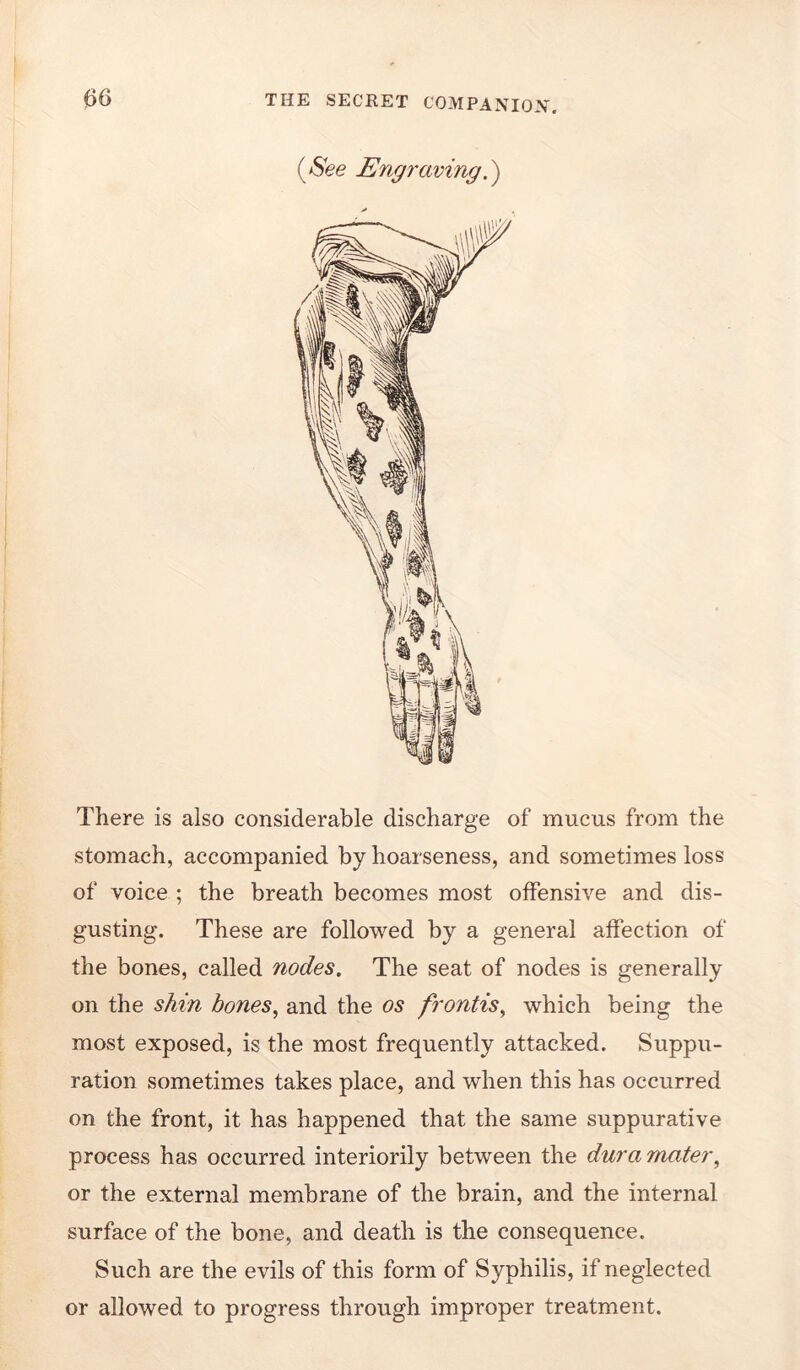 (^See Engo'aving There is also considerable discharge of mucus from the stomach, accompanied by hoarseness, and sometimes loss of voice ; the breath becomes most offensive and dis- gusting. These are followed by a general affection of the bones, called nodes. The seat of nodes is generally on the shin hones^ and the os frontis^ which being the most exposed, is the most frequently attacked. Suppu- ration sometimes takes place, and when this has occurred on the front, it has happened that the same suppurative process has occurred interiorily between the dura mater^ or the external membrane of the brain, and the internal surface of the bone, and death is the consequence. Such are the evils of this form of Syphilis, if neglected or allowed to progress through improper treatment.