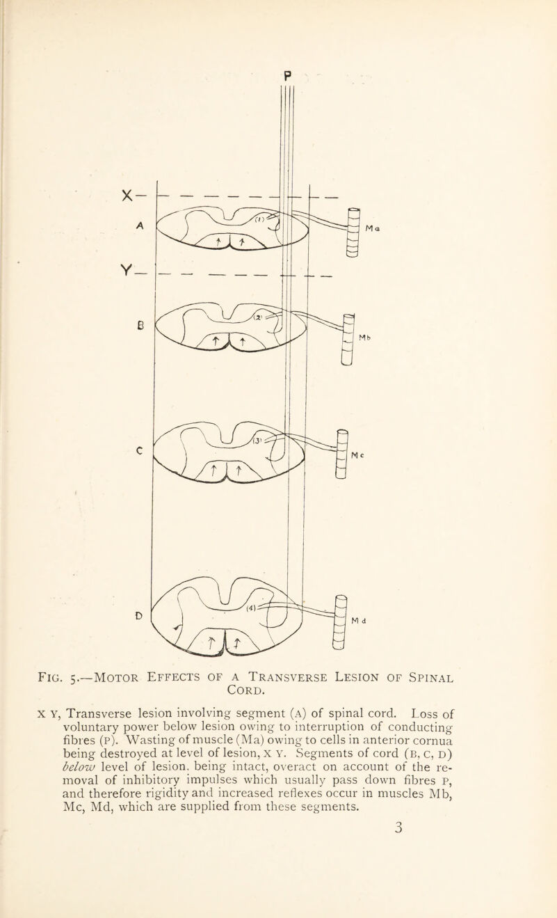 p Fig. 5.—Motor Effects of a Transverse Lesion of Spinal Cord. X y, Transverse lesion involving segment (a) of spinal cord. Loss of voluntary power below lesion owing to interruption of conducting fibres (p). Wasting of muscle (Ma) owing to cells in anterior cornua being destroyed at level of lesion, x Y. Segments of cord (b, c, d) below level of lesion, being intact, overact on account of the re¬ moval of inhibitory impulses which usually pass down fibres p, and therefore rigidity and increased reflexes occur in muscles Mb, Me, Md, which are supplied from these segments. 3