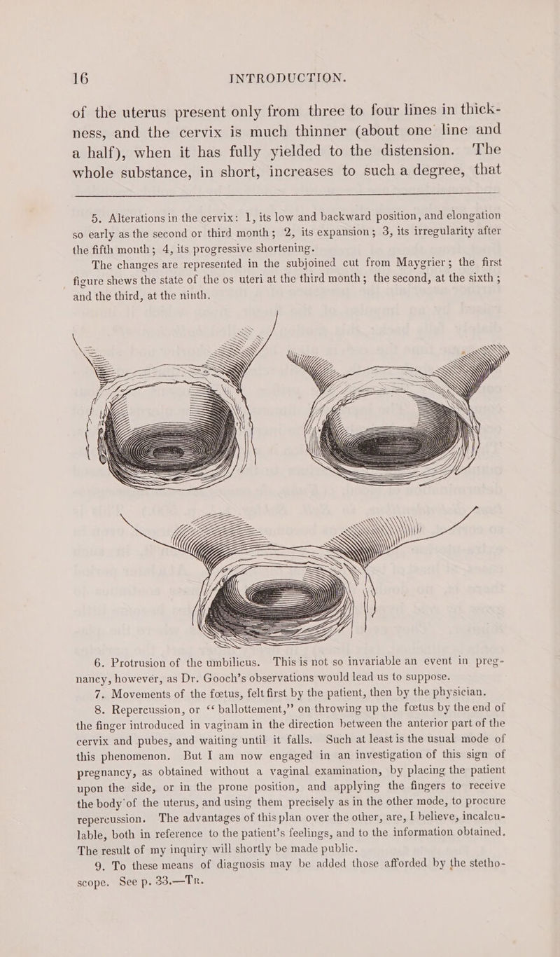 of the uterus present only from three to four lines in thick- ness, and the cervix is much thinner (about one line and a half), when it has fully yielded to the distension. The whole substance, in short, increases to such a degree, that 5, Alterations in the cervix: 1, its low and backward position, and elongation so early as the second or third month; 2, its expansion; 3, its irregularity after the fifth month; 4, its progressive shortening. The changes are represented in the subjoined cut from Maygrier; the first _ figure shews the state of the os uteri at the third month; the second, at the sixth ; and the third, at the ninth. 6. Protrusion of the umbilicus. This is not so invariable an event in preg- nancy, however, as Dr. Gooch’s observations would lead us to suppose. 7. Movements of the foetus, felt first by the patient, then by the physician. 8. Repercussion, or ‘* ballottement,”’ on throwing up the foetus by the end of the finger introduced in vaginam in the direction between the anterior part of the cervix and pubes, and waiting until it falls. Such at least is the usual mode of this phenomenon. But I am now engaged in an investigation of this sign of pregnancy, as obtained without a vaginal examination, by placing the patient upon the side, or in the prone position, and applying the fingers to receive the body of the uterus, and using them precisely as in the other mode, to procure repercussion. The advantages of this plan over the other, are, I believe, incalcu- lable, both in reference to the patient’s feelings, and to the information obtained. The result of my inquiry will shortly be made public. 9. To these means of diagnosis may be added those afforded by the stetho- scope. See p. 33.—Tr.