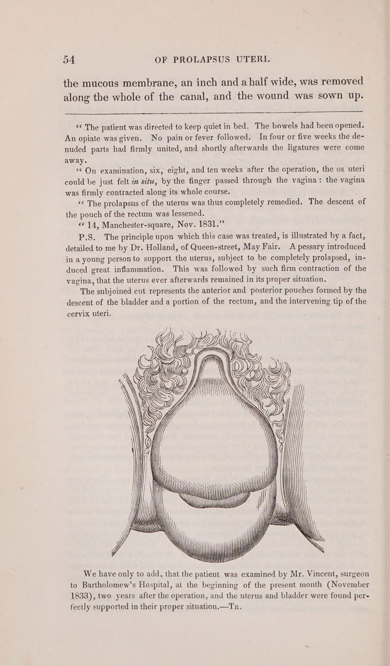 the mucous membrane, an inch and a half wide, was removed along the whole of the canal, and the wound was sown up. “6 The patient was directed to keep quiet in bed. The bowels had been opened. An opiate was given. No pain or fever followed. In four or five weeks the de- nuded parts had firmly united, and shortly afterwards the ligatures were come away. &lt;¢ On examination, six, eight, and ten weeks after the operation, the os uteri could be just felt iz situ, by the finger passed through the vagina: the vagina was firmly contracted along its whole course. ‘© The prolapsus of the uterus was thus completely remedied. The descent of the pouch of the rectum was lessened. ‘€ 14, Manchester-square, Nov. 1831.” P.S. The principle upon which this case was treated, is illustrated by a fact, detailed to me by Dr. Holland, of Queen-street, May Fair. A pessary introduced in a young person to support the uterus, subject to be completely prolapsed, in- duced great inflammation. This was followed by such firm contraction of the vagina, that the uterus ever afterwards remained in its proper situation. The subjoined cut represents the anterior and posterior pouches formed by the descent of the bladder and a portion of the rectum, and the intervening tip of the cervix uteri. 1 | Less | | eas lh » We have only to add, that the patient was examined by Mr. Vincent, surgeon to Bartholomew’s Hospital, at the beginning of the present month (November 1833), two years after the operation, and the uterus and bladder were found per- fectly supported in their proper situation.—Tr. KL x