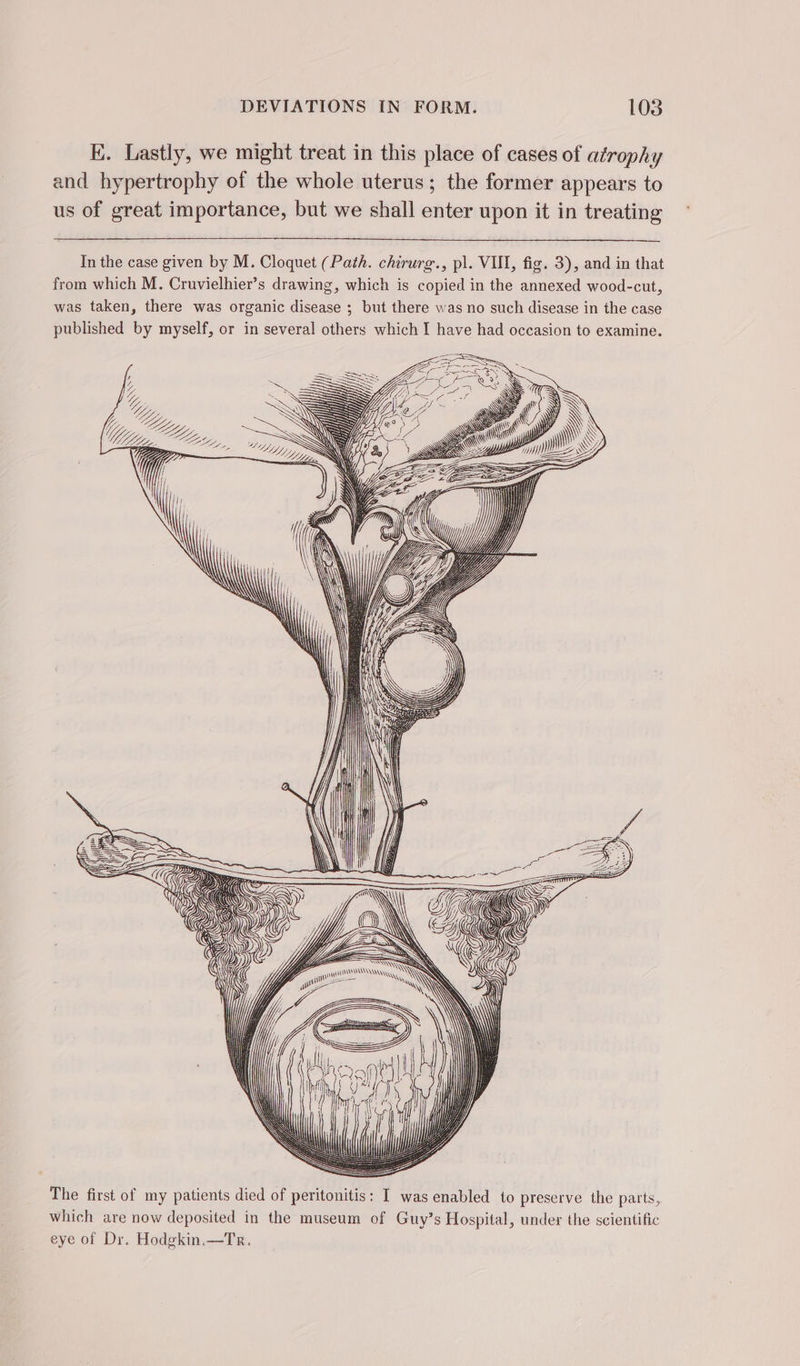 E. Lastly, we might treat in this place of cases of atrophy and hypertrophy of the whole uterus; the former appears to us of great importance, but we shall enter upon it in treating In the case given by M. Cloquet (Path. chirurg., pl. VIL, fig. 3), and in that from which M. Cruvielhier’s drawing, which is copied in the annexed wood-cut, was taken, there was organic disease ; but there was no such disease in the case published by myself, or in several others which I have had occasion to examine. The first of my patients died of peritonitis: I was enabled to preserve the parts, which are now deposited in the museum of Guy’s Hospital, under the scientific eye of Dr. Hodekin.—Tr.