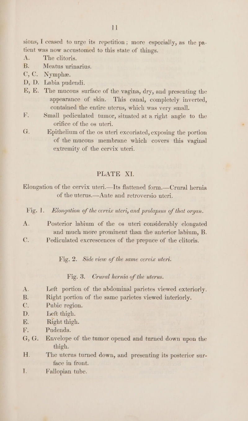 1] sions, I ceased to urge its repetition; more especially, as the pa- tient was now accustomed to this state of things. A. The clitoris. B. Meatus urinarius. C,C. Nymphæ. D, D. Labia pudendi. E, E. The mucous surface of the vagina, dry, and presenting the appearance of skin. This canal, completely inverted, contained the entire uterus, which was very small. F. Small pediculated tumor, situated at a right angle to the orifice of the os uteri. G. Epithelium of the os uteri excoriated, exposing the portion of the mucous membrane which covers this vaginal extremity of the cervix uteri. PLATE XI. Elongation of the cervix uteri—Its flattened form.—Crural hernia of the uterus.—Ante and retroversio uteri. Fig. 1. Elongation of the cervix uteri, and prolapsus of that organ. À Posterior labium of the os uteri considerably elongated and much more prominent than the anterior labium, B. C. Pediculated excrescences of the prepuce of the clitoris. Fig. 2. Side view of the same cervix uteri. Fig. 3. Crural hernia of the uterus. Left portion of the abdominal parietes viewed exteriorly. Right portion of the same parietes viewed interiorly. Pubic region. Left thigh. Right thigh. Pudenda. Envelope of the tumor opened and turned down upon the thigh. The uterus turned down, and presenting its posterior sur- face in front. Fallopian tube. QAO OD Er: A nl