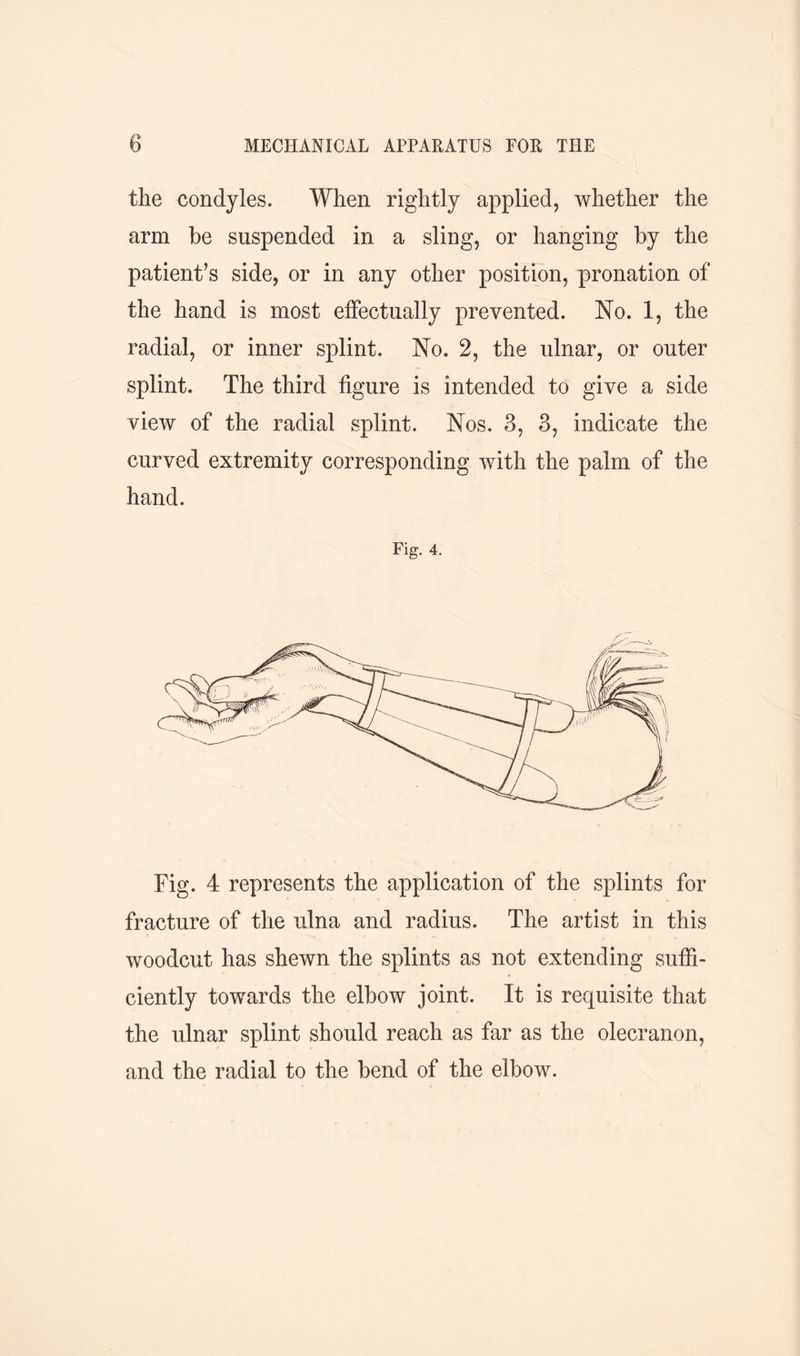 the condyles. When rightly applied, whether the arm be suspended in a sling, or hanging by the patient’s side, or in any other position, pronation of the hand is most effectually prevented. No. 1, the radial, or inner splint. No. 2, the ulnar, or outer splint. The third figure is intended to give a side view of the radial splint. Nos. 3, 3, indicate the curved extremity corresponding with the palm of the hand. Fig. 4. Fig. 4 represents the application of the splints for fracture of the ulna and radius. The artist in this woodcut has shewn the splints as not extending suffi- ciently towards the elbow joint. It is requisite that the ulnar splint should reach as far as the olecranon, and the radial to the bend of the elbow.