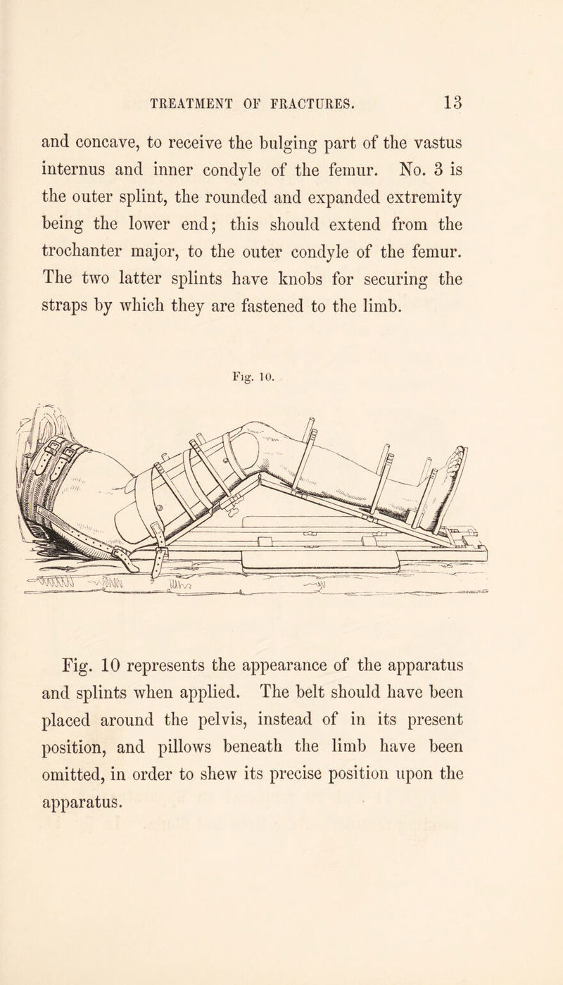 and concave, to receive the bulging part of the vastus internus and inner condyle of the femur. No. 3 is the outer splint, the rounded and expanded extremity being the lower end; this should extend from the trochanter major, to the outer condyle of the femur. The two latter splints have knobs for securing the straps by which they are fastened to the limb. Fig. 10. Fig. 10 represents the appearance of the apparatus and splints when applied. The belt should have been placed around the pelvis, instead of in its present position, and pillows beneath the limb have been omitted, in order to shew its precise position upon the apparatus. ijy