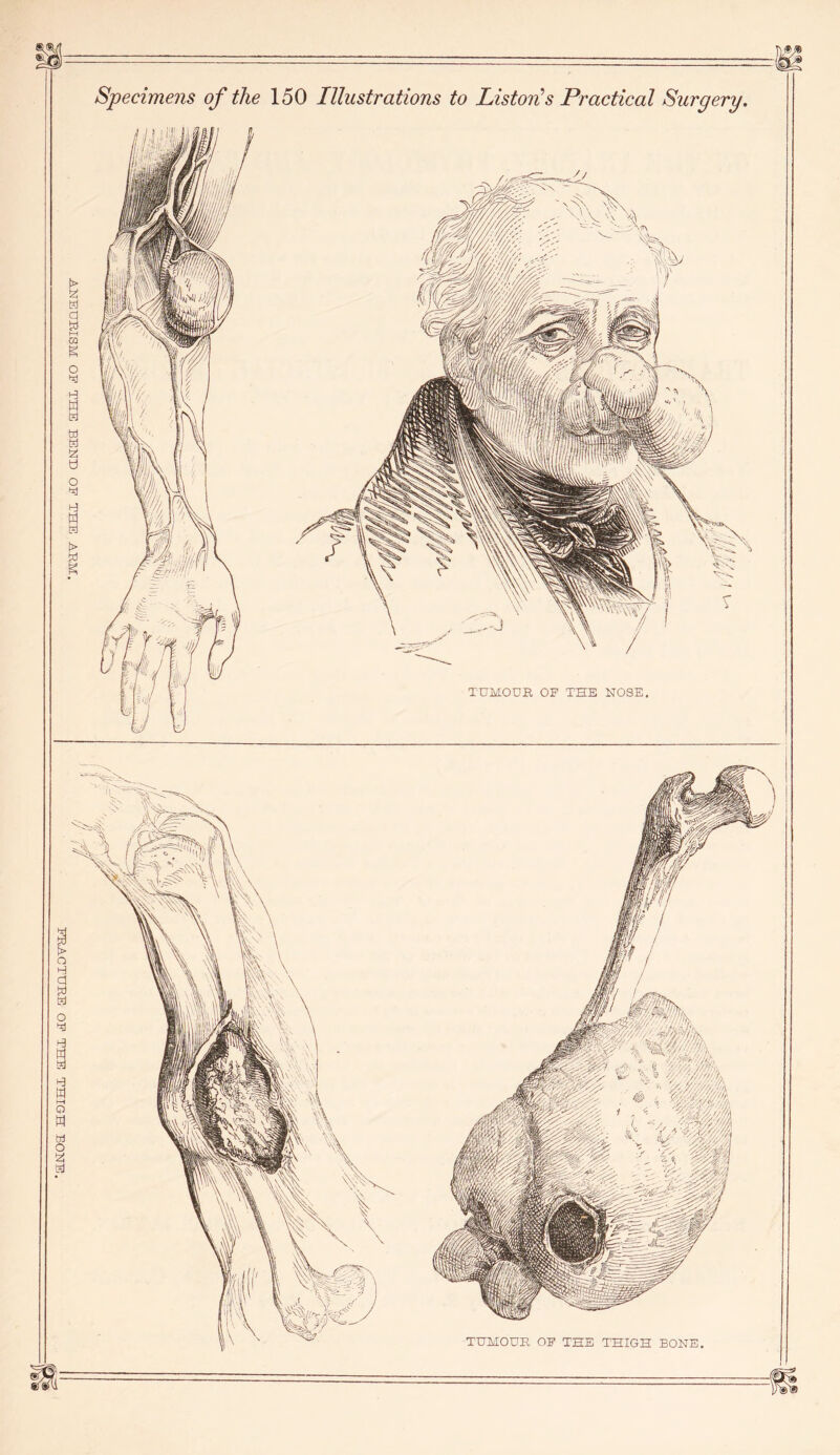 FRACTURE OF THE THIGH BONE.