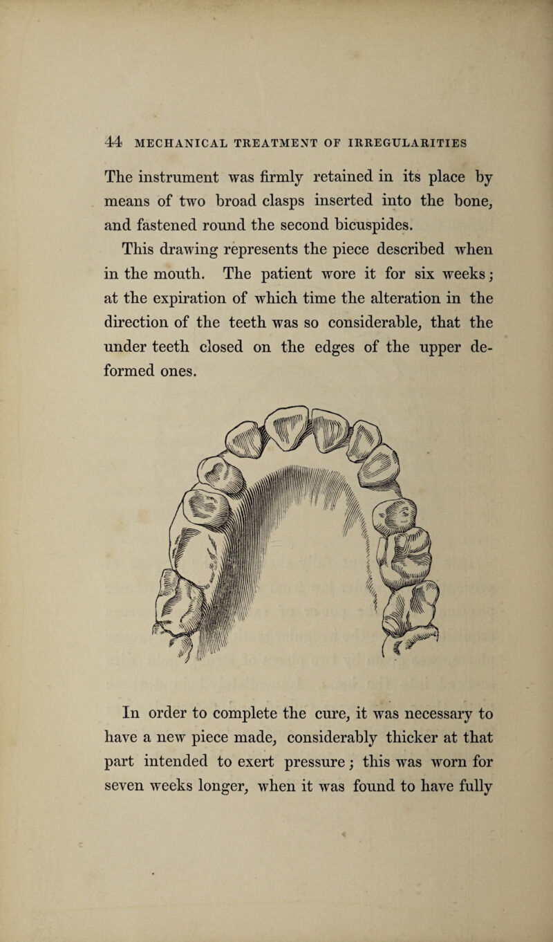 The instrument was firmly retained in its place by means of two broad clasps inserted into the bone, and fastened round the second bicuspides. This drawing represents the piece described when in the mouth. The patient wore it for six weeks; at the expiration of which time the alteration in the direction of the teeth was so considerable, that the under teeth closed on the edges of the upper de¬ formed ones. In order to complete the cure, it was necessary to have a new piece made, considerably thicker at that part intended to exert pressure; this was worn for seven weeks longer, when it was found to have fully