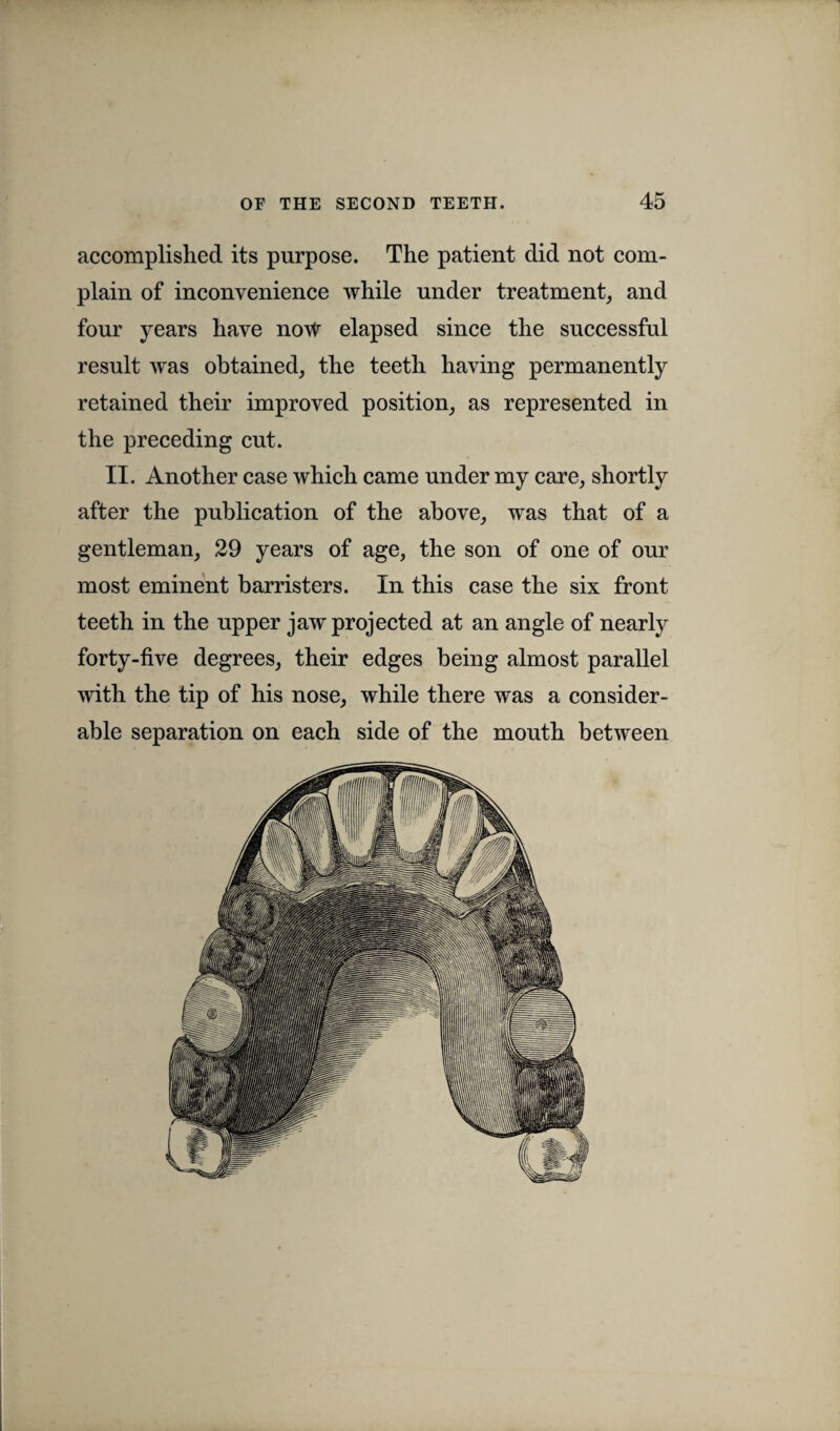 accomplished its purpose. The patient did not com¬ plain of inconvenience while under treatment, and four years have no\t elapsed since the successful result was obtained, the teeth having permanently retained their improved position, as represented in the preceding cut. II. Another case which came under my care, shortly after the publication of the above, was that of a gentleman, 29 years of age, the son of one of our most eminent barristers. In this case the six front teeth in the upper jaw projected at an angle of nearly forty-five degrees, their edges being almost parallel with the tip of his nose, while there was a consider¬ able separation on each side of the mouth between