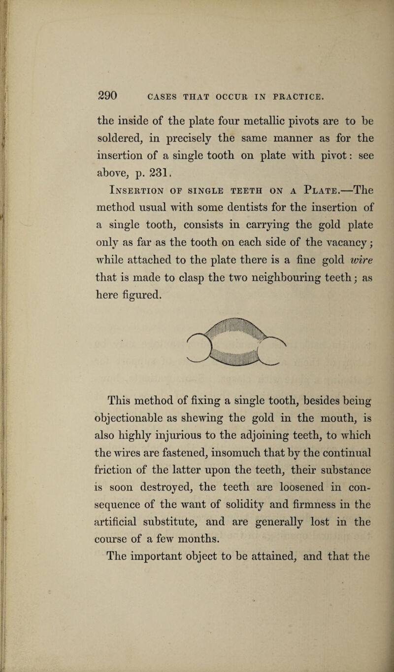 the inside of the plate four metallic pivots are to be soldered, in precisely the same manner as for the insertion of a single tooth on plate with pivot: see above, p. 231. Insertion oe single teeth on a Plate.—The method usual with some dentists for the insertion of a single tooth, consists in carrying the gold plate only as far as the tooth on each side of the vacancy; while attached to the plate there is a fine gold wire that is made to clasp the two neighbouring teeth; as here figured. This method of fixing a single tooth, besides being objectionable as shewing the gold in the mouth, is also highly injurious to the adjoining teeth, to which the wires are fastened, insomuch that by the continual friction of the latter upon the teeth, their substance is soon destroyed, the teeth are loosened in con¬ sequence of the want of solidity and firmness in the artificial substitute, and are generally lost in the course of a few months. The important object to be attained, and that the