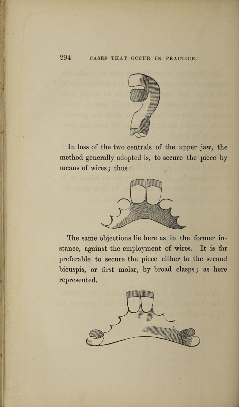 In loss of the two centrals of the upper jaw, the method generally adopted is, to secure the piece by means of wires; thus : The same objections lie here as in the former in¬ stance, against the employment of wires. It is far preferable to secure the piece either to the second bicuspis, or first molar, by broad clasps; as here represented.