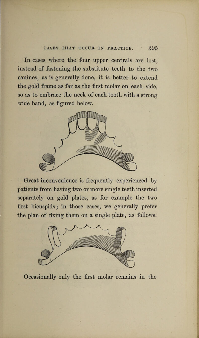 In cases where the four upper centrals are lost, instead of fastening the substitute teeth to the two canines, as is generally done, it is better to extend the gold frame as far as the first molar on each side, so as to embrace the neck of each tooth with a strong wide band, as figured below. Great inconvenience is frequently experienced by patients from having two or more single teeth inserted separately on gold plates, as for example the two first bicuspids; in those cases, we generally prefer the plan of fixing them on a single plate, as follows. Occasionally only the first molar remains in the