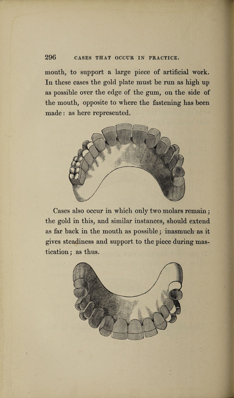 mouth, to support a large piece of artificial work. In these cases the gold plate must be run as high up as possible over the edge of the gum, on the side of the mouth, opposite to where the fastening has been made : as here represented. Cases also occur in which only two molars remain; the gold in this, and similar instances, should extend as far back in the mouth as possible; inasmuch as it gives steadiness and support to the piece during mas¬ tication ; as thus.