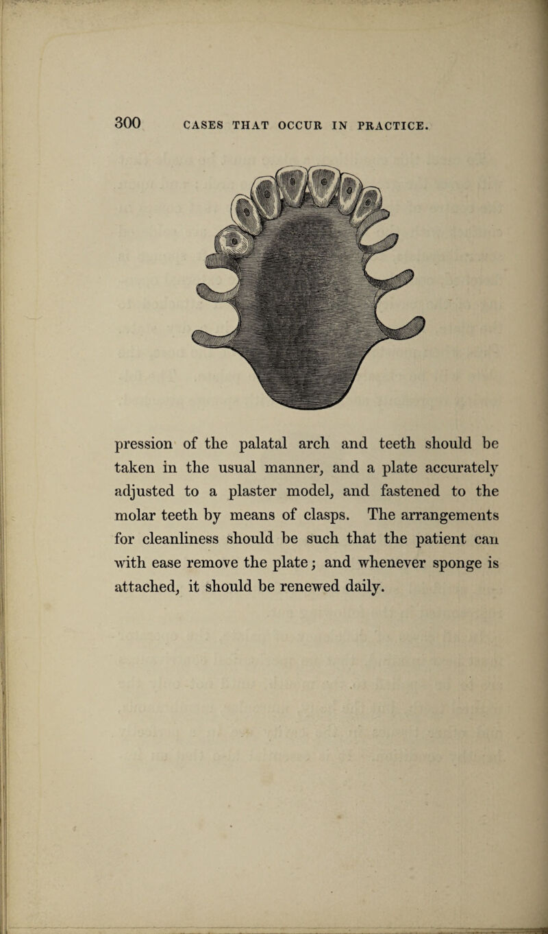 pression of the palatal arch and teeth should be taken in the usual manner, and a plate accurately adjusted to a plaster model, and fastened to the molar teeth by means of clasps. The arrangements for cleanliness should be such that the patient can with ease remove the plate; and whenever sponge is attached, it should be renewed daily.