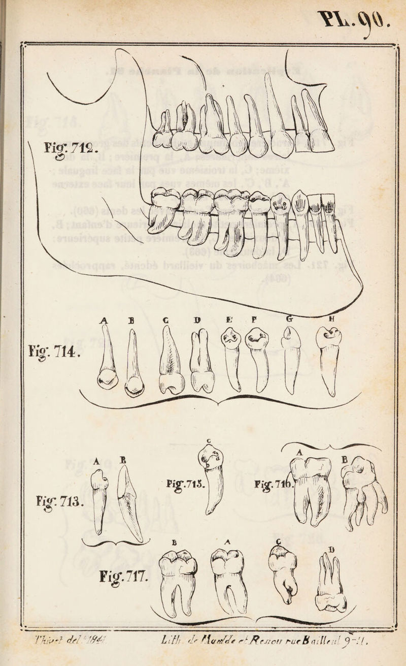 468. Procédés employés pour réduire celle luxai ion. (Pro¬ cédé d'Aslley Cooper.) (PI. 57, fig. 457.) « Laréductiondecette luxation s’opère en général avec beaucoup de facilité si l’ac¬ cident est récent. Il faut coucher le malade sur le dos, écarter les cuisses autant que possible, et placer entre les parties gé¬ nitales et la partie supérieure du membre luxé, une ceinture transversale que Ton attache à un anneau fixé dans la muraille. Alors le chirurgien plaçant la main sur le coude-pied, tire sur la jambe en croisant celle du côté sain en avant, ou bien en arrière si la cuisse est très volumineuse. Cette manœuvre suffit pour faire glisser la tête du fémur dans sa cavité. J’ai vu réduire ainsi avec une grande facilité, à l’hôpital Saint- Thomas, une luxation très récente. Dans un cas de celle na¬ ture , la cuisse peut être fixée par un montant de lit reçu entre les parties génitales et la partie supérieure du membre, pendant que la jambe est portée en dedans de manière à croiser celle du côté opposé. Mais, en général, il est néces¬ saire de fixer le bassin par une ceinture dirigée transversa¬ lement et passant par dessus le chef antérieur de celle qui a été placée autour de la partie supérieure de la cuisse et à laquelle les poulies doivent être attachées, autrement le bas¬ sin sera entraîné avec la tête du fémur. Dans les cas où la luxation existe depuis trois ou quatre semaines, il vaut mieux faire placer le malade sur le côté sain, fixer le bassin par une ceinture, et porter sous le membre luxé une autre cein¬ ture à laquelle les poulies doivent être fixées perpendicu¬ lairement. On tire alors la cuisse en haut, tandis que le chi¬ rurgien appuie sur le genou et sur le pied pour empê¬ cher la partie inférieure du membre d’être élevée avec le fémur: le membre se trouve ainsi transformé en un levier dont la force est considérable. Il faut avoir grand soin de ne pas trop porter la jambe en avant, car la tête du fémur se¬ rait entraînée en arrière de la cavité cotyloïde, dans l’échan¬ crure sciatique, d’où l’on ne pourrait plus ensuite la déga-