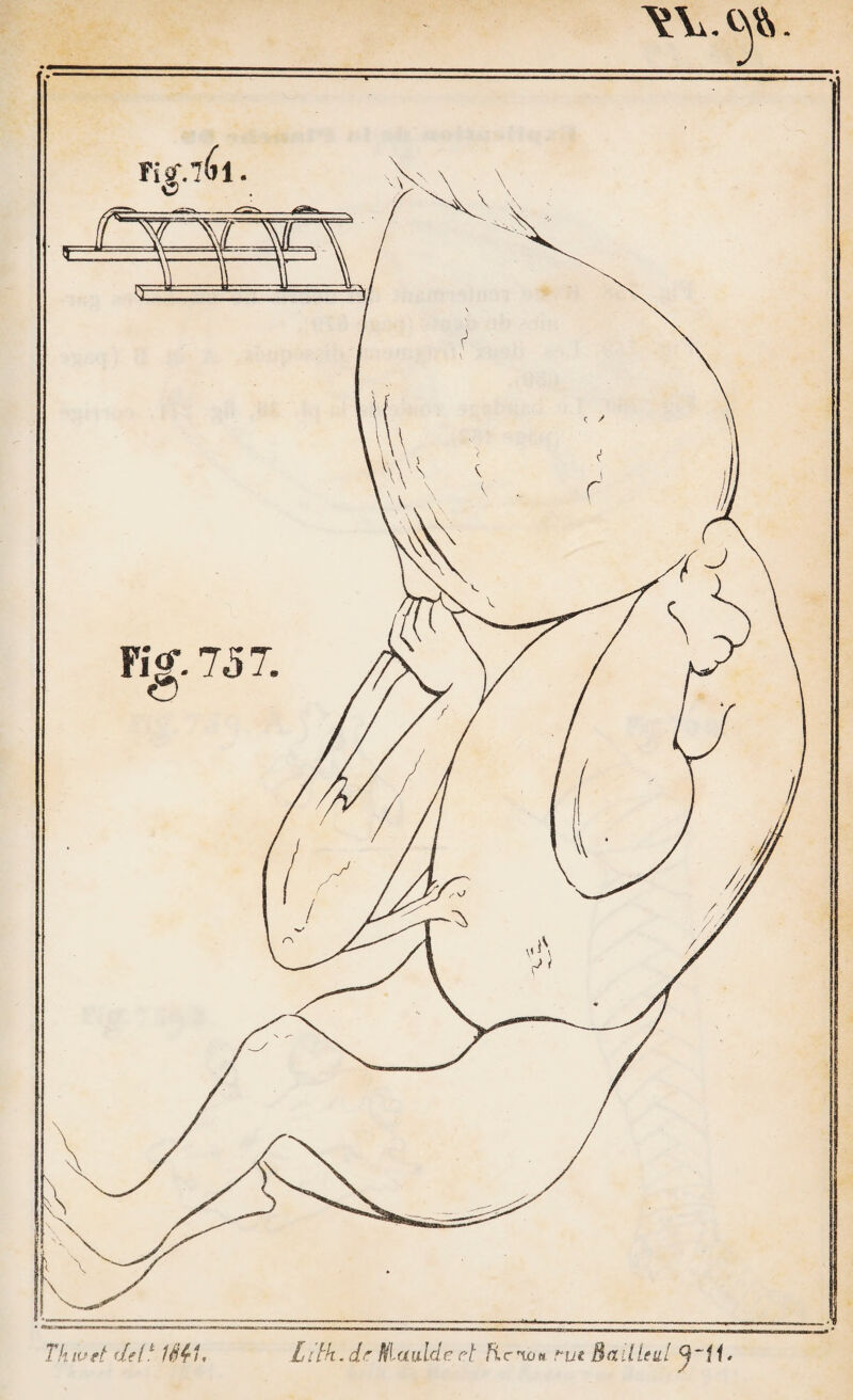 — 110 — PRKHIKRi; SKCTIOM. - B41»4GI>§ 4 H.iMDl'll SOIP4ES. PREMIER GENRE. CIRCULAIRE LARGE CONTENTIF DE LA POITRINE. (BANDAGE DE CORPS. ) 166. Pièces nécessaires. Une serviette pliée en trois et pou¬ vant faire un peu plus que le tour du corps. Application. Placez la partie moyenne du plein de la ser¬ viette en arrière, ramenez-en les extrémités sur le sternum en ayant soin d’en appliquer une et puis l'autre par dessus ; on maintient le tout avec trois ou quatre épingles ( pl. 18 , fig. 148). Remarque. Ce bandage est employé dans le cas de fracture des côtes , pour empêcher leurs mouvemens , pour mainte¬ nir un emplâtre ou un vésicatoire sur un point quelconque de la poitrine : dans le premier cas il devient circulaire ré- ductif. Il est rare qu’on se serve exclusivement de ce circu¬ laire ; ordinairement on le maintient par deux jets de bandes en forme de bretelles, qu’on nomme en chirurgie scapulaires. Il forme alors un autre bandage qu’on nomme T double de la poitrine (193). / A moins de contre-indication il faut toujours, à cause du décubitus dorsal, fixer la serviette en avant. Le bandage cor¬ respondant du nouveau système est exactement le même; seulement c’est une serviette de coton qui, af>rès son applica¬ tion , prend le nom de rectangle dorso-thoracique. PREMIER GENRE. CIRCULAIRE LARGE CONTENTIF DE L’ABDOMEN. 167. Pièce déligatoire. Une serviette pliée en trois comme dans le bandage précédent. Application. Placez la partie moyenne du plein sur les lom¬ bes, et ramenez les extrémités sur le ventre pour les croiser et les fixer avec des épingles.