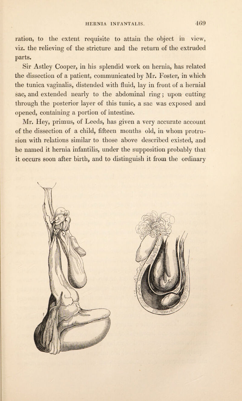 ration, to the extent requisite to attain the object in view, viz. the relieving of the stricture and the return of the extruded parts. Sir Astley Cooper, in his splendid work on hernia, has related the dissection of a patient, communicated by Mr. Foster, in which the tunica vaginalis, distended with fluid, lay in front of a hernial sac, and extended nearly to the abdominal ring; upon cutting through the posterior layer of this tunic, a sac was exposed and opened, containing a portion of intestine. Mr. Hey, primus, of Leeds, has given a very accurate account of the dissection of a child, fifteen months old, in whom protru¬ sion with relations similar to those above described existed, and he named it hernia infantilis, under the supposition probably that it occurs soon after birth, and to distinguish it from the ordinary