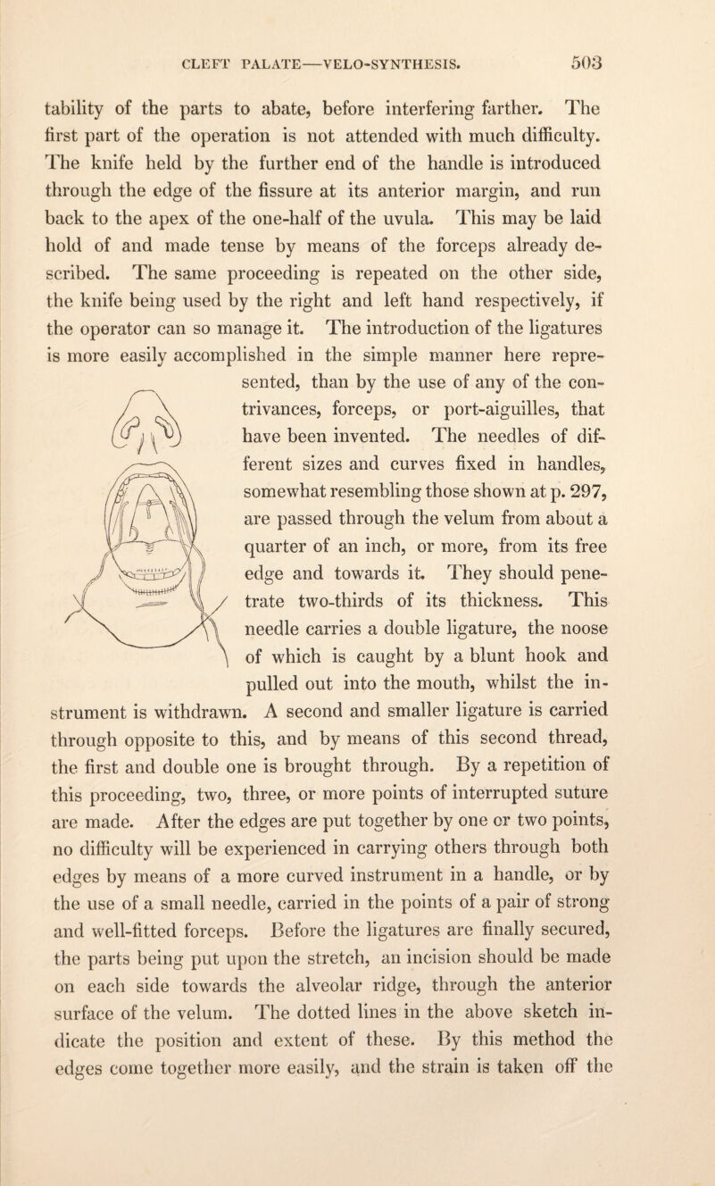 tability of the parts to abate, before interfering farther. The first part of the operation is not attended with much difficulty. The knife held by the further end of the handle is introduced through the edge of the fissure at its anterior margin, and run back to the apex of the one-half of the uvula. This may be laid hold of and made tense by means of the forceps already de¬ scribed. The same proceeding is repeated on the other side, the knife being used by the right and left hand respectively, if the operator can so manage it. The introduction of the ligatures is more easily accomplished in the simple manner here repre¬ sented, than by the use of any of the con¬ trivances, forceps, or port-aiguilles, that have been invented. The needles of dif¬ ferent sizes and curves fixed in handles, somewhat resembling those shown at p. 297, are passed through the velum from about a quarter of an inch, or more, from its free edge and towards it. They should pene¬ trate two-thirds of its thickness. This needle carries a double ligature, the noose of which is caught by a blunt hook and pulled out into the mouth, whilst the in¬ strument is withdrawn. A second and smaller ligature is carried through opposite to this, and by means of this second thread, the first and double one is brought through. By a repetition of this proceeding, two, three, or more points of interrupted suture are made. After the edges are put together by one or two points, no difficulty will be experienced in carrying others through both edges by means of a more curved instrument in a handle, or by the use of a small needle, carried in the points of a pair of strong and well-fitted forceps. Before the ligatures are finally secured, the parts being put upon the stretch, an incision should be made on each side towards the alveolar ridge, through the anterior surface of the velum. The dotted lines in the above sketch in¬ dicate the position and extent of these. By this method the edges come together more easily, and the strain is taken off the