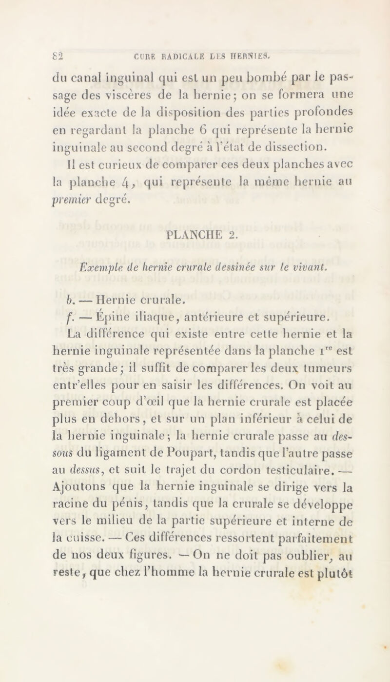 du canal inguinal qui esl un peu bombé par le pas- sage des viscères de la hernie; on se formera une idée exacte de la disposition des parties profondes en regardant la planche G qui représente la hernie inguinale au second degré à l’état de dissection. Il est curieux de comparer ces deux planches avec la planche i\, qui représente la même hernie au premier degré. PLANCHE 2. Exemple, de hernie crurale dessinée sur le vivant. b. ■— Hernie crurale. f. — Épine iliaque, antérieure et supérieure. La différence qui existe entre cette hernie et la hernie inguinale représentée dans la planche ire est très grande; il suffit de comparer les deux tumeurs entr’elles pour en saisir les différences. On voit au premier coup d’œil que la hernie crurale est placée plus en dehors, et sur un plan inférieur à celui de la hernie inguinale; la hernie crurale passe au des- sous du ligament de Poupart, tandis que l’autre passe au dessus, et suit le trajet du cordon testiculaire. — Ajoutons que la hernie inguinale se dirige vers la racine du pénis, tandis que la crurale se développe vers le milieu de la partie supérieure et interne de la cuisse. — Ces différences ressortent parfaitement de nos deux figures. — On ne doit pas oublier, au reste, que chez l’homme la hernie crurale est plutôt