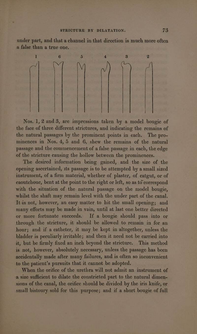 under part, and that a channel in that direction is much more often a false than a true one. 1 6 5 4 3 Q- Nos. 1, 2 and 3, are impressions taken by a model bougie of the face of three different strictures, and indicating the remains of the natural passages by the prominent points in each. The pro- minences in Nos. 4,5 and 6, shew the remains of the natural passage and the commencement of a false passage in each, the edge of the stricture causing the hollow between the prominences. The desired information being gained, and the size of the opening ascertained, 1ts passage is to be attempted by a small sized instrument, of a firm material, whether of plaster, of catgut, or of caoutchouc, bent at the point to the right or left, so as to correspond with the situation of the natural passage on the model bougie, whilst the shaft may remain level with the under part of the canal. It as not, however, an easy matter to hit the small opening; and many efforts may be made in vain, until at last one better directed or more fortunate succeeds. If a bougie should pass into or through the stricture, it should be allowed to remain in for an hour; and if a catheter, it may be kept in altogether, unless the bladder is peculiarly irritable; and then it need not be carried into it, but be firmly fixed an inch beyond the stricture. This method is not, however, absolutely necessary, unless the passage has been accidentally made after many failures, and is often so inconvenient to the patient’s pursuits that it cannot be adopted. When the orifice of the urethra will not admit an instrument of a size sufficient to dilate the constricted part to the natural dimen- sions of the canal, the orifice should be divided by the iris knife, or small bistoury sold for this purpose; and if a short bougie of full