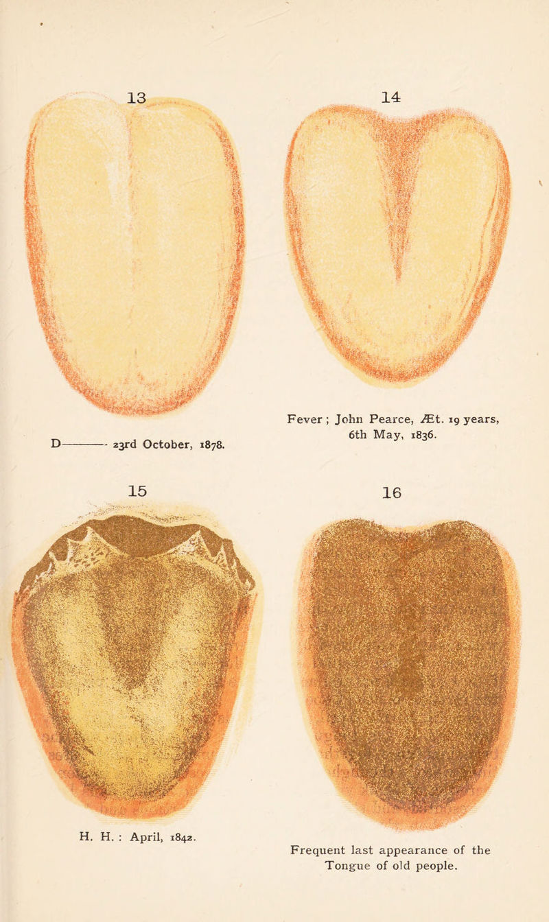 13 D-- 23rd October, 1878. 14 Fever ; John Pearce, JEt. 19 years, 6th May, 1836. H. H. : April, 1842 Frequent last appearance of the Tongue of old people.