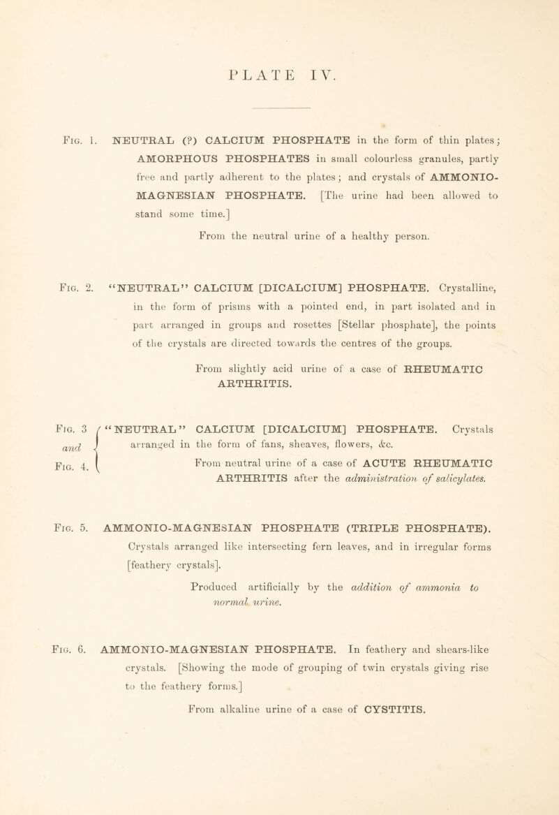 Fig. 1. NEUTRAL (?) CALCIUM PHOSPHATE in the form of thin plates; AMORPHOUS PHOSPHATES in small colourless granules, partly free and partly adherent to the plates; and crystals of AMMONIO- M AGNESI AN PHOSPHATE. [The urine had been allowed to stand some time.] From the neutral urine of a healthy person. Fig. 2. “NEUTRAL” CALCIUM [DICALCIUM] PHOSPHATE. Crystalline, in the form of prisms with a pointed end, in part isolated and in part arranged in groups and rosettes [Stellar phosphate], the points of the crystals are directed towards the centres of the groups. From slightly acid urine of a case of RHEUMATIC ARTHRITIS. Fig. 3 and Fig. 4. “NEUTRAL” CALCIUM [DICALCIUM] PHOSPHATE. Crystals arranged in the form of fans, sheaves, flowers, &c. From neutral urine of a case of ACUTE RHEUMATIC ARTHRITIS after the administration of salicylates. Fig. 5. AMMONIO-MAGNESIAN PHOSPHATE (TRIPLE PHOSPHATE). Crystals arranged like intersecting fern leaves, and in irregular forms [feather}- crystals]. Produced artificially by the addition of ammonia to normal urine. Fig. 6. AMMONIO-MAGNESIAN PHOSPHATE. In feathery and shears-like crystals. [Showing the mode of grouping of twin crystals giving rise to the feathery forms.] From alkaline urine of a case of CYSTITIS.