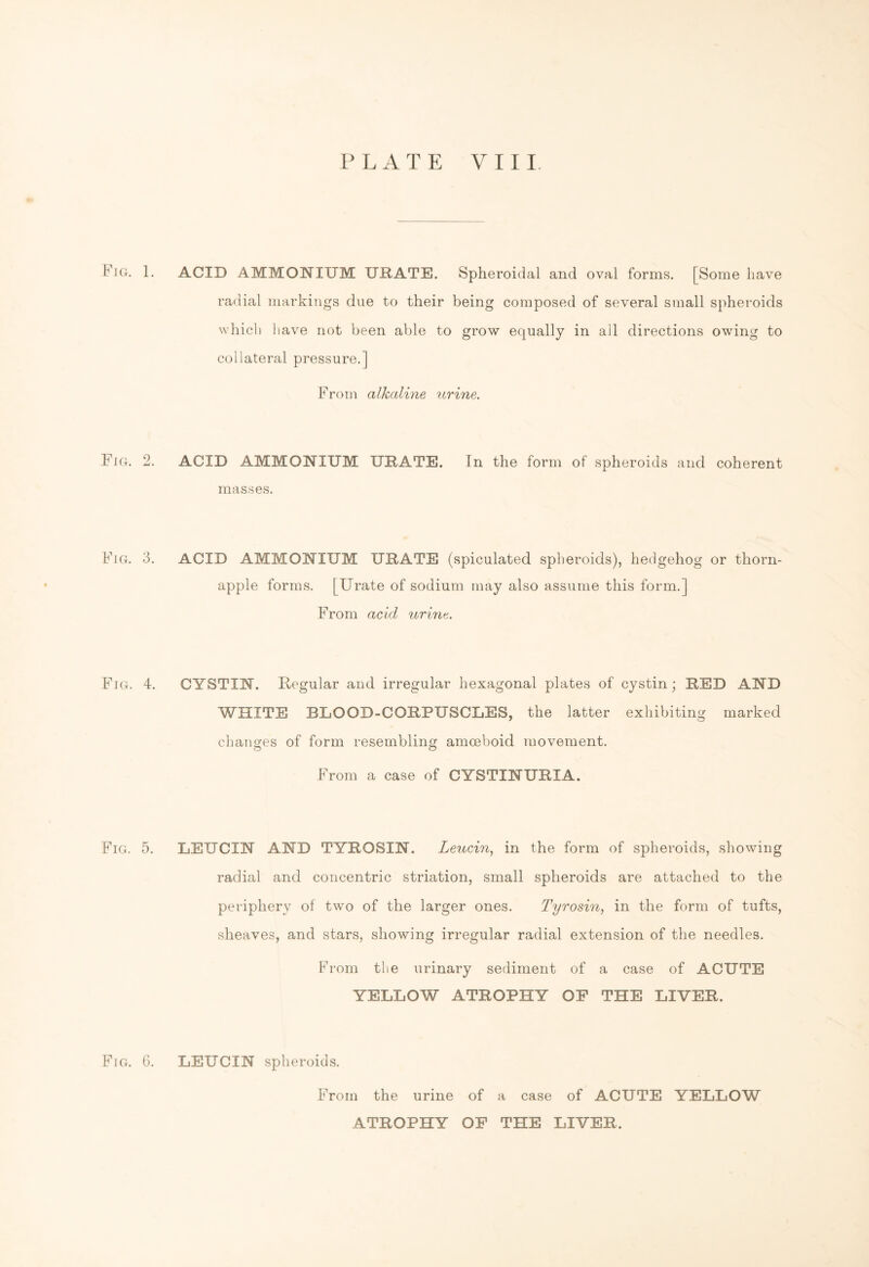 Fig. 1. ACID AMMONIUM URATE. Spheroidal and oval forms. [Some have radial markings due to their being composed of several small spheroids which have not been able to grow equally in all directions owing to collateral pressure.] From alkaline urine. Fig. 2. ACID AMMONIUM URATE. In the form of spheroids and coherent masses. Fig. 3. ACID AMMONIUM URATE (spiculated spheroids), hedgehog or thorn- apple forms. [Urate of sodium may also assume this form.] From acid urine. Fig. 4. CYSTIN. Regular and irregular hexagonal plates of cystin; RED AND WHITE BLOOD-CORPUSCLES, the latter exhibiting marked chancres of form resembling amoeboid movement. o o From a case of CYSTINURIA. Fig. 5. LEUCIN AND TYROSIN. Leucin, in the form of spheroids, showing radial and concentric striation, small spheroids are attached to the periphery of two of the larger ones. Tyrosin, in the form of tufts, sheaves, and stars, showing irregular radial extension of the needles. From the urinary sediment of a case of ACUTE YELLOW ATROPHY OF THE LIVER. Fig. 6. LEUCIN spheroids. From the urine of a case of ACUTE YELLOW ATROPHY OF THE LIVER.