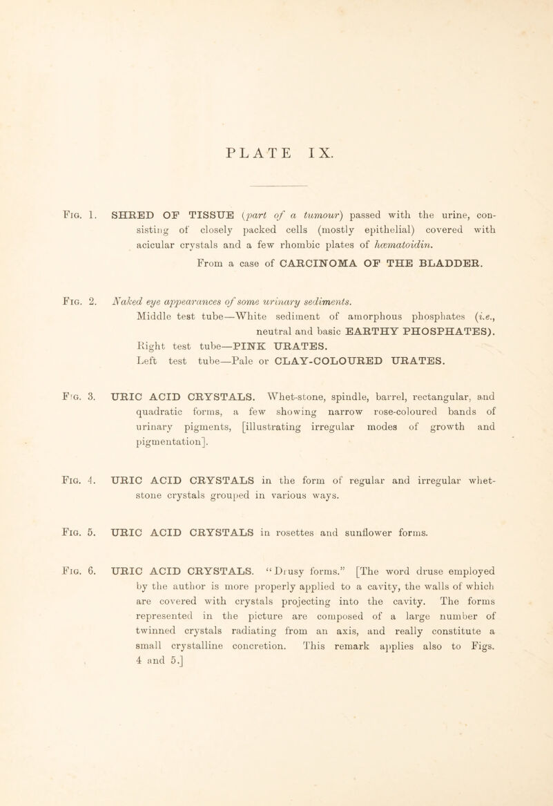 Fig. 1. SHRED OF TISSUE {part of a tumour) passed with the urine, con¬ sisting of closely packed cells (mostly epithelial) covered with acicular crystals and a few rhombic plates of licematoidin. From a case of CARCINOMA OF THE BLADDER. Fig. 2. Naked eye appearances of some urinary sediments. Middle test tube—White sediment of amorphous phosphates (he., neutral and basic EARTHY PHOSPHATES). Right test tube—PINK URATES. Left test tube—Pale or CLAY-COLOURED URATES. FrG. 3. URIC ACID CRYSTALS. Whet-stone, spindle, barrel, rectangular, and quadratic forms, a few showing narrow rose-coloured bands of urinary pigments, [illustrating irregular modes of growth and pigmentation]. Fig. 4. URIC ACID CRYSTALS in the form of regular and irregular whet¬ stone crystals grouped in various ways. Fig. 5. URIC ACID CRYSTALS in rosettes and sunflower forms. Fig. 6. URIC ACID CRYSTALS. “Drusy forms.” [The word druse employed by the author is more properly applied to a cavity, the walls of which are covered with crystals projecting into the cavity. The forms represented in the picture are composed of a large number of twinned crystals radiating from an axis, and really constitute a small crystalline concretion. This remark applies also to Figs. 4 and 5.]