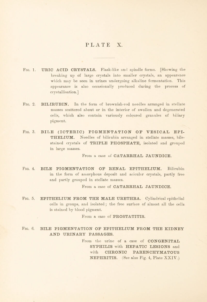 Fig. 1. URIC ACID CRYSTALS. Flask-like and spindle forms. [Showing the breaking up of large crystals into smaller crystals, an appearance which may be seen in urines undergoing alkaline fermentation. This appearance is also occasionally produced during the process of crystallisation.] Fig. 2. BILIRUBIN. In the form of brownish-red needles arranged in stellate masses scattered about or in the interior of swollen and degenerated cells, which also contain variously coloured granules of biliary pigment. Fig. 3. BILE (ICTERIC) PIGMENTATION OF VESICAL EPI¬ THELIUM. Needles of bilirubin arranged in stellate masses, bile- stained crystals of TRIPLE PHOSPHATE, isolated and grouped in large masses. From a case of CATARRHAL JAUNDICE. Fig. 4. BILE PIGMENTATION OF RENAL EPITHELIUM. Bilirubin in the form of amorphous deposit and acicular crystals, partly free and partly grouped in stellate masses. From a case of CATARRHAL JAUNDICE. Fig. 5. EPITHELIUM FROM THE MALE URETHRA. Cylindrical epithelial cells in groups, and isolated ; the free surface of almost all the cells is stained by blood pigment. From a case of PROSTATITIS. Fig. 6. BILE PIGMENTATION OF EPITHELIUM FROM THE KIDNEY AND URINARY PASSAGES. From the urine of a case of CONGENITAL SYPHILIS with HEPATIC LESIONS and with CHRONIC PARENCHYMATOUS NEPHRITIS. (See also Fig. 4, Plate XXIV.)