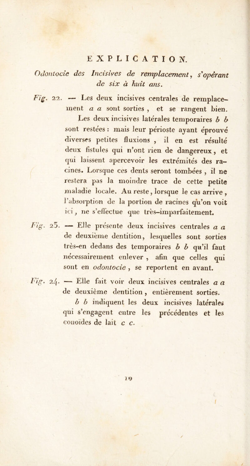 Odontocie des Incisives de remplacement, s'opérant de six à huit ans. Fig. 22. — Les deux incisives centrales de remplace- ment a a sont sorties , et se rangent bien. Les deux incisives latérales temporaires b b sont restées : mais leur périoste ayant éprouvé diverses petites fluxions , il en est résulté deux fistules qui n’ont rien de dangereux , et qui laissent apercevoir les extrémités des ra- cines. Lorsque ces dents seront tombées , il ne restera pas la moindre trace de cette petite maladie locale. Au reste, lorsque le cas arrive , l’absorption de la portion de racines qu’on voit ici ne s’effectue que très-imparfaitement. Fig. 25. — Elle présente deux incisives centrales a a de deuxième dentition, lesquelles sont sorties très-en dedans des temporaires b b qu’il faut nécessairement enlever , afin que celles qui sont en odontocie , se reportent en avant. Fig. 24. — Elle fait voir deux incisives centrales a a de deuxième dentition, entièrement sorties. b b indiquent les deux incisives latérales qui s’engagent entre les précédentes et les conoïdes de lait c c. ï o /