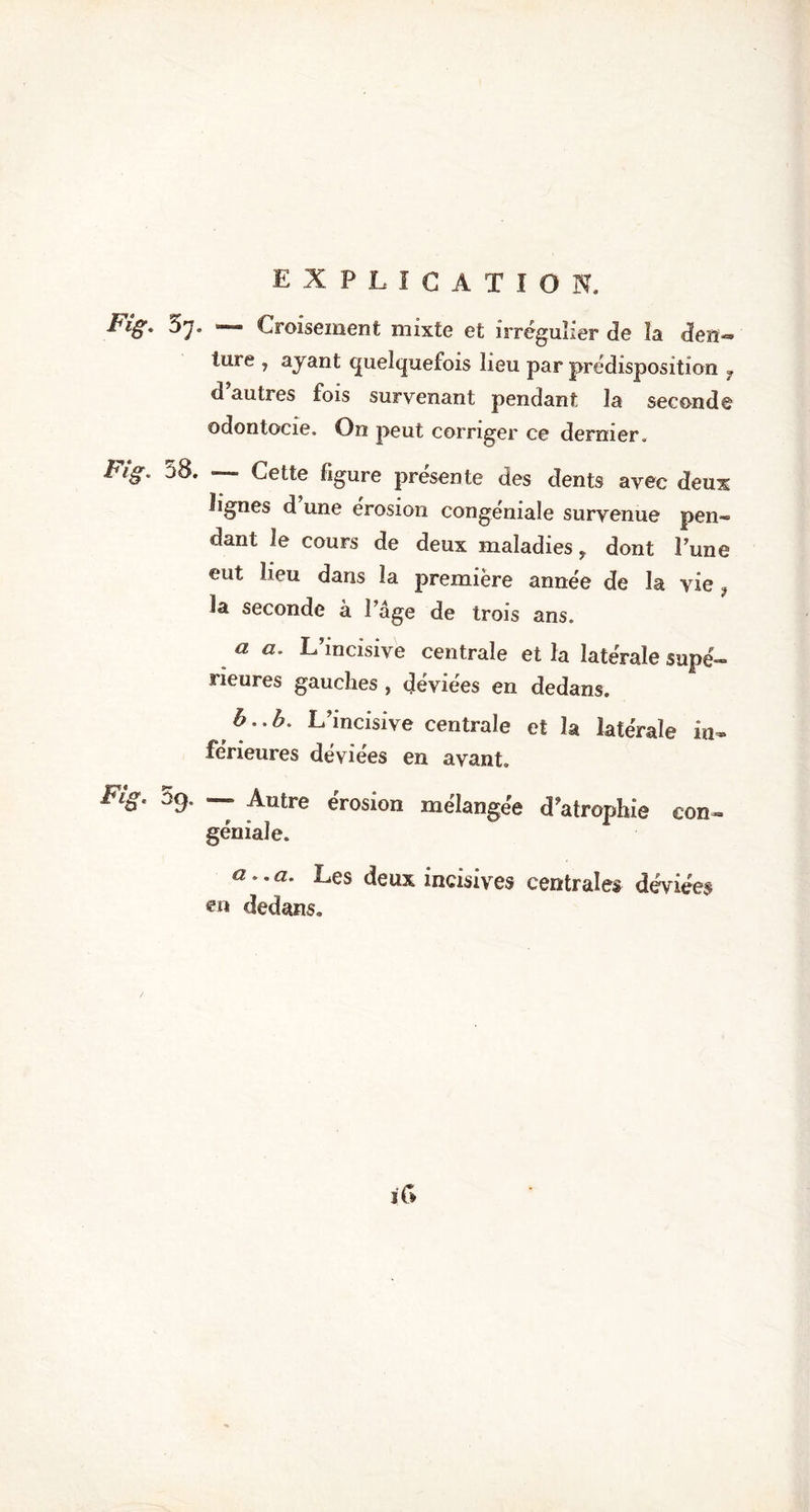 à'j. — Croisement mixte et irrégulier de la den« lure , ayant quelquefois lieu par prédisposition 7 d’autres fois survenant pendant la seconde odontocie. On peut corriger ce dernier. Fïg. 58. — Cette figure présente des dents avec deux lignes d’une érosion congéniaîe survenue pen- dant le cours de deux maladies, dont l’une eut lieu dans la première année de la vie } la seconde à l’âge de trois ans. a «. L’incisive centrale et la latérale supé- rieures gauches , déviées en dedans. h L’incisive centrale et la latérale in- férieures déviées en avant. Fig. 39. — Autre érosion mélangée d’atrophie con- géniale. 1 a..a. Les deux incisives centrales déviées dedans* i G